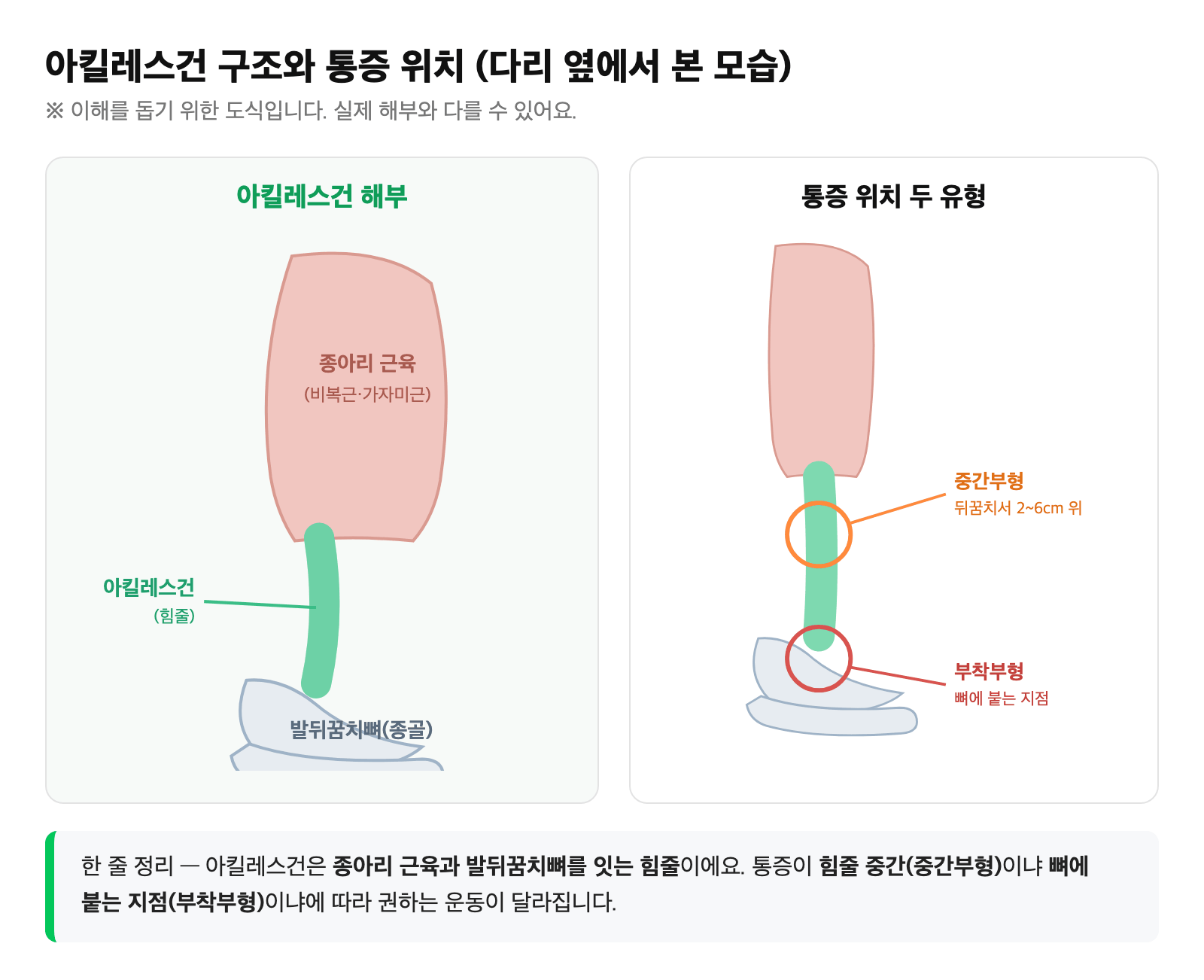 종아리 근육과 발뒤꿈치 뼈를 잇는 아킬레스건의 해부 구조와, 힘줄 중간부·뼈 부착부 통증 위치를 단순화한 도식