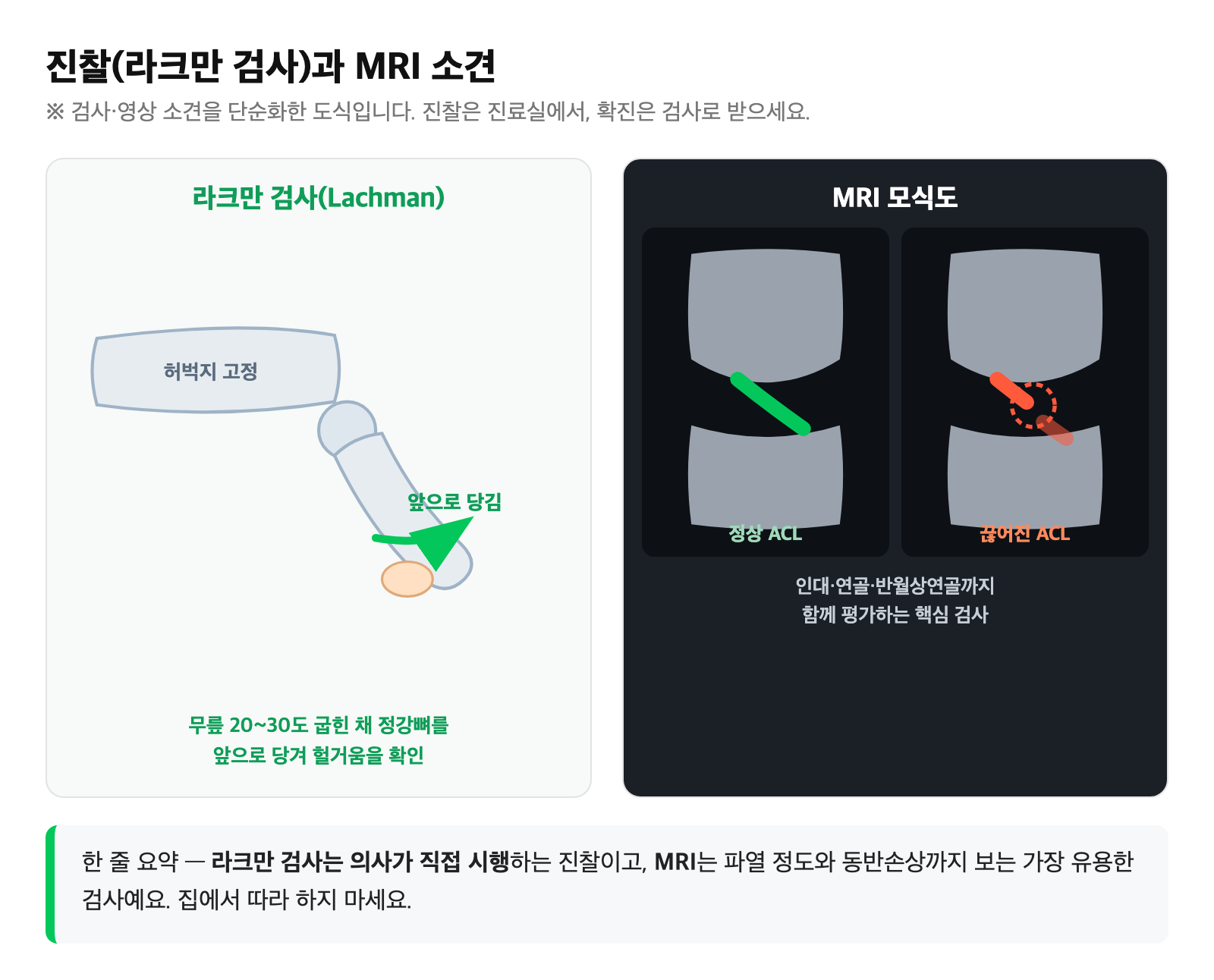 라크만 검사와 MRI 정상·끊어진 십자인대 비교 모식도