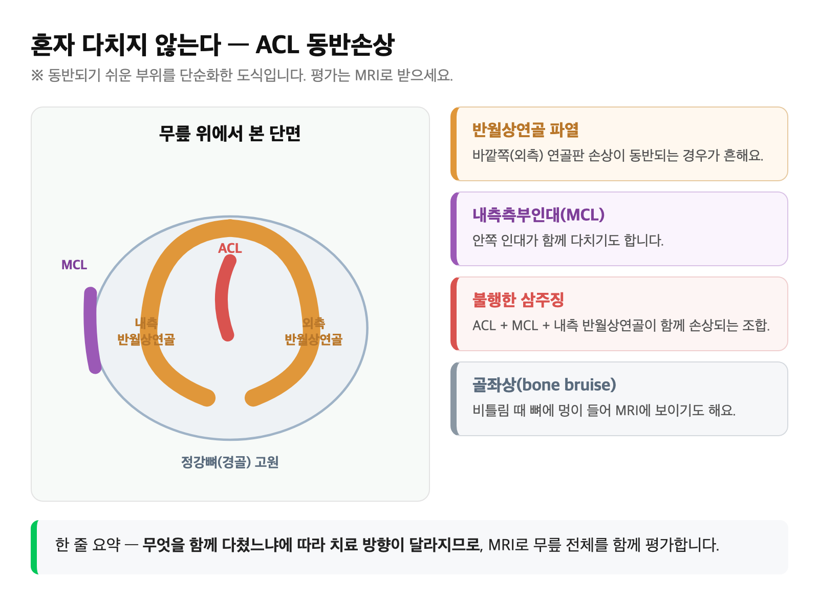 무릎 전방십자인대·반월상연골·내측측부인대 위치와 ACL 동반손상 비교 도식