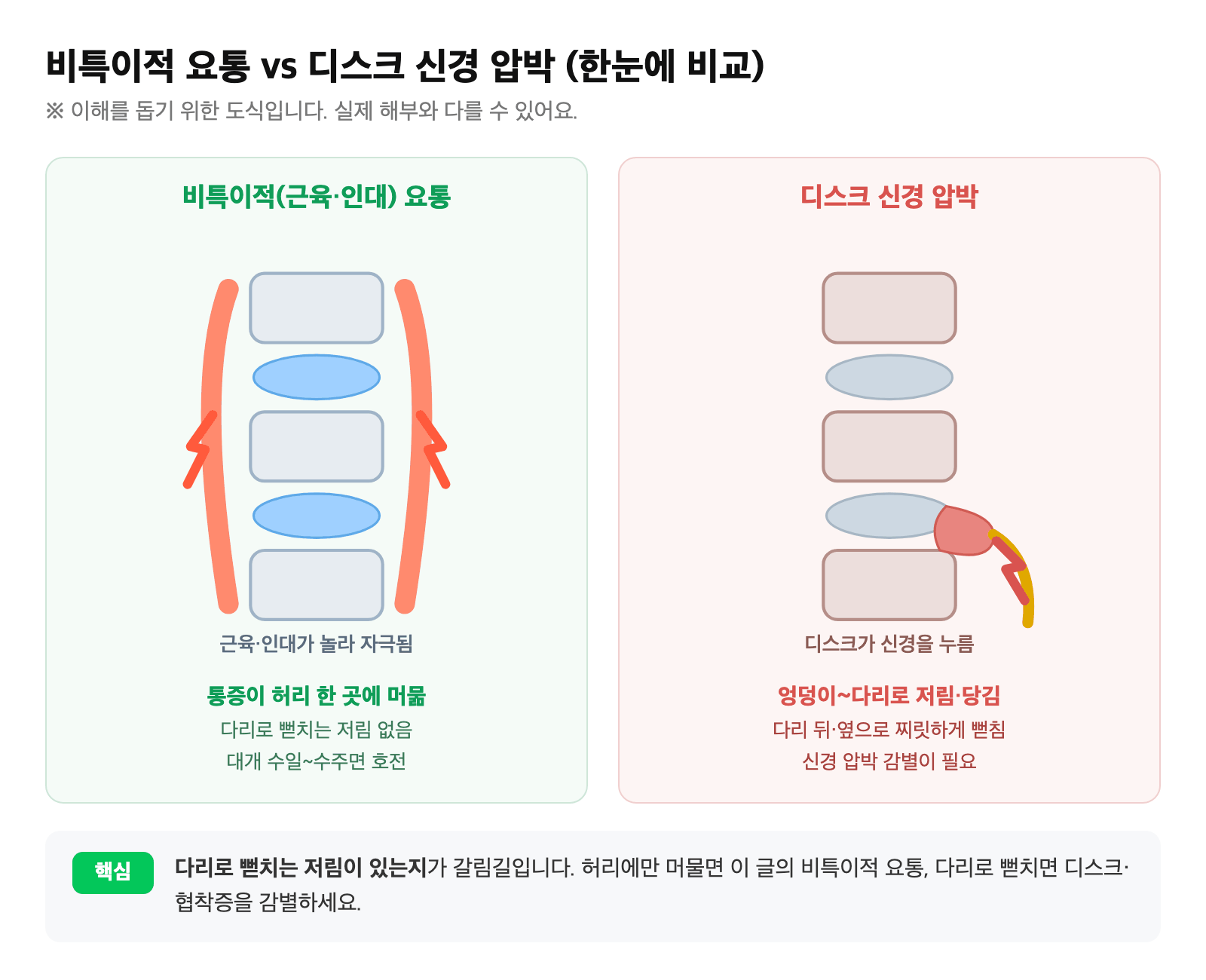 허리 근육·인대가 놀란 비특이적 요통과, 디스크가 신경을 눌러 다리로 뻗치는 통증을 한눈에 비교한 도식
