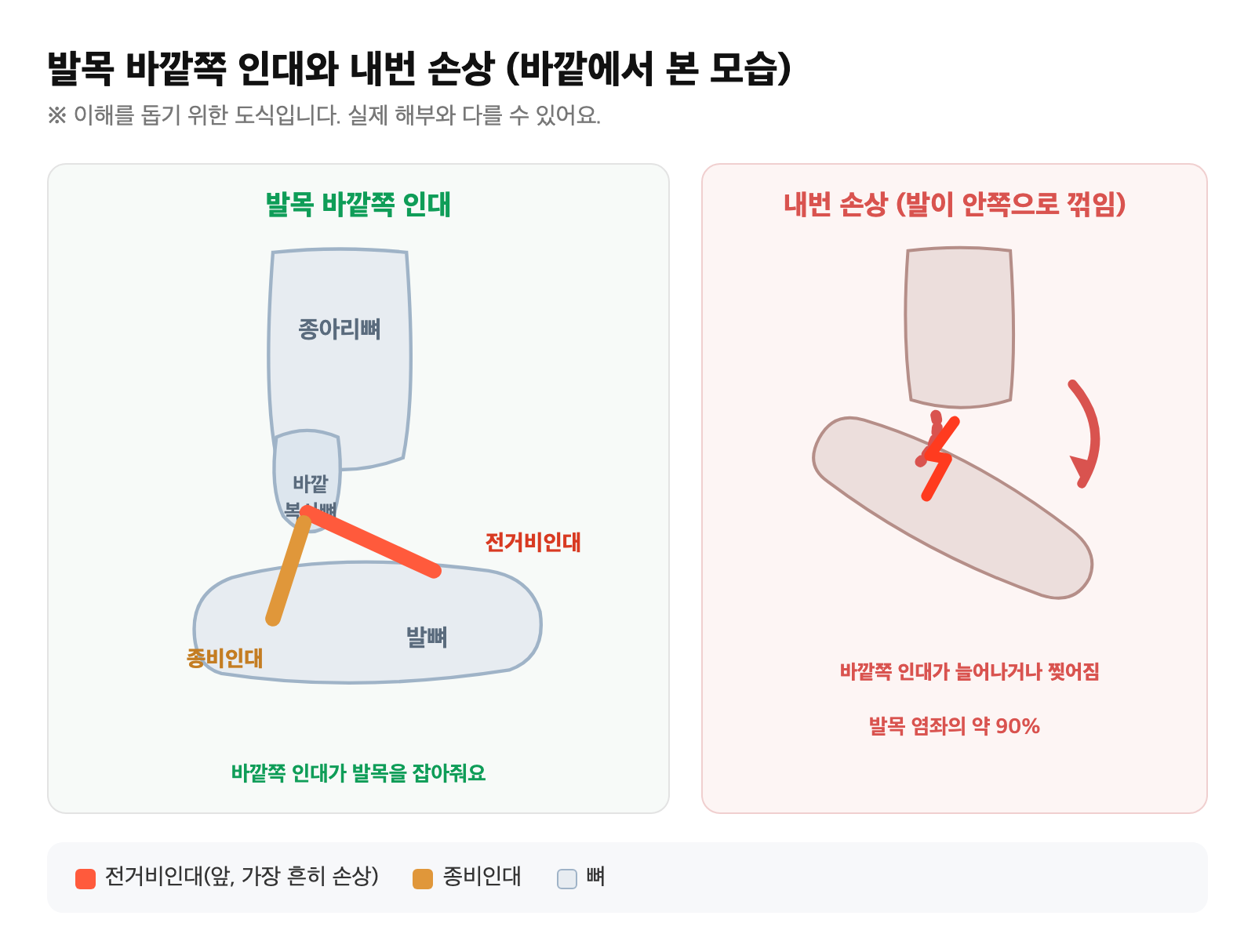 발목 바깥쪽 인대(전거비인대·종비인대)와 발이 안쪽으로 꺾이는 내번 손상 도식