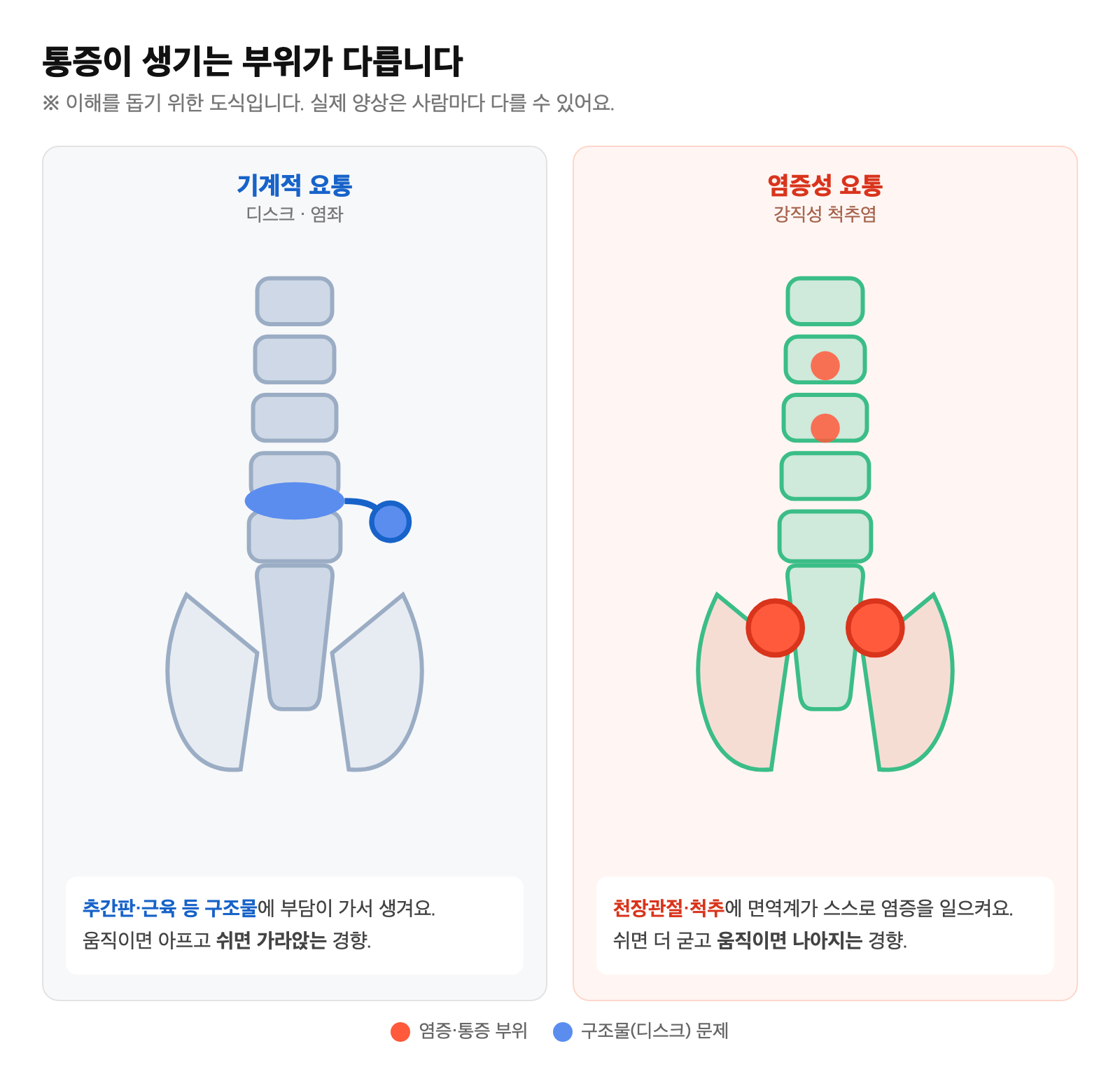 척추와 천장관절(엉치엉덩관절)의 위치를 표시하고, 기계적 요통(디스크·염좌)과 염증성 요통(강직성 척추염)이 생기는 부위·원리를 나란히 비교한 일러스트