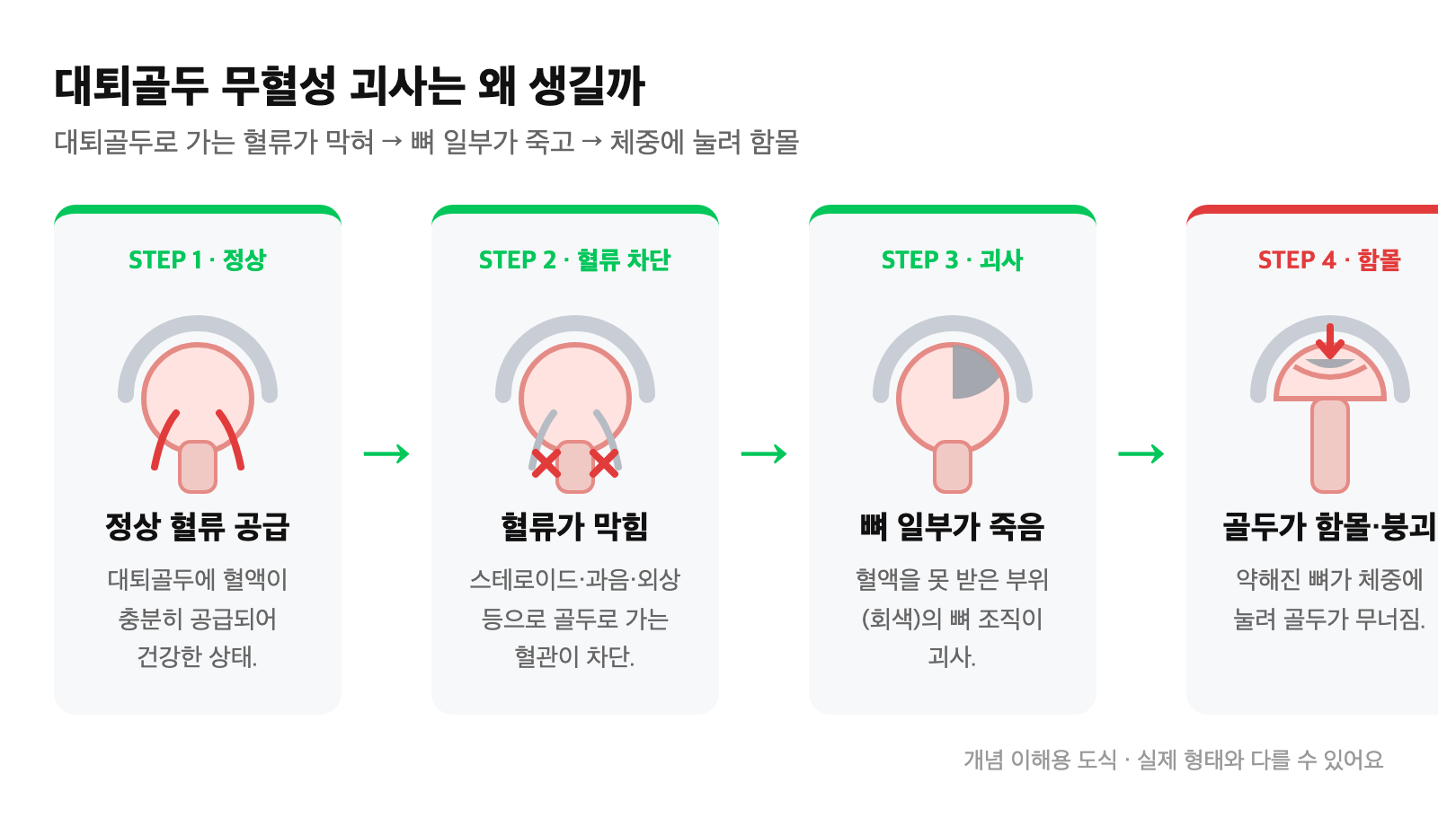 대퇴골두로 가는 혈류가 차단되어 뼈 일부가 괴사하고 진행 시 골두가 함몰되는 과정을 단계로 보여주는 개념 도식