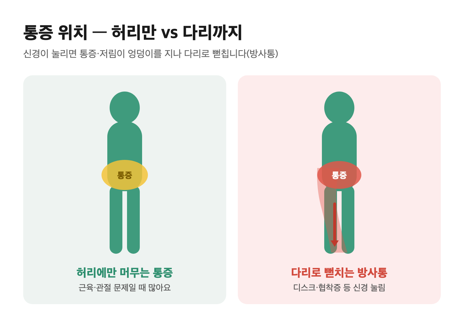 허리에만 머무는 통증과 엉덩이를 지나 다리로 뻗치는 방사통을 비교한 인체 모식도