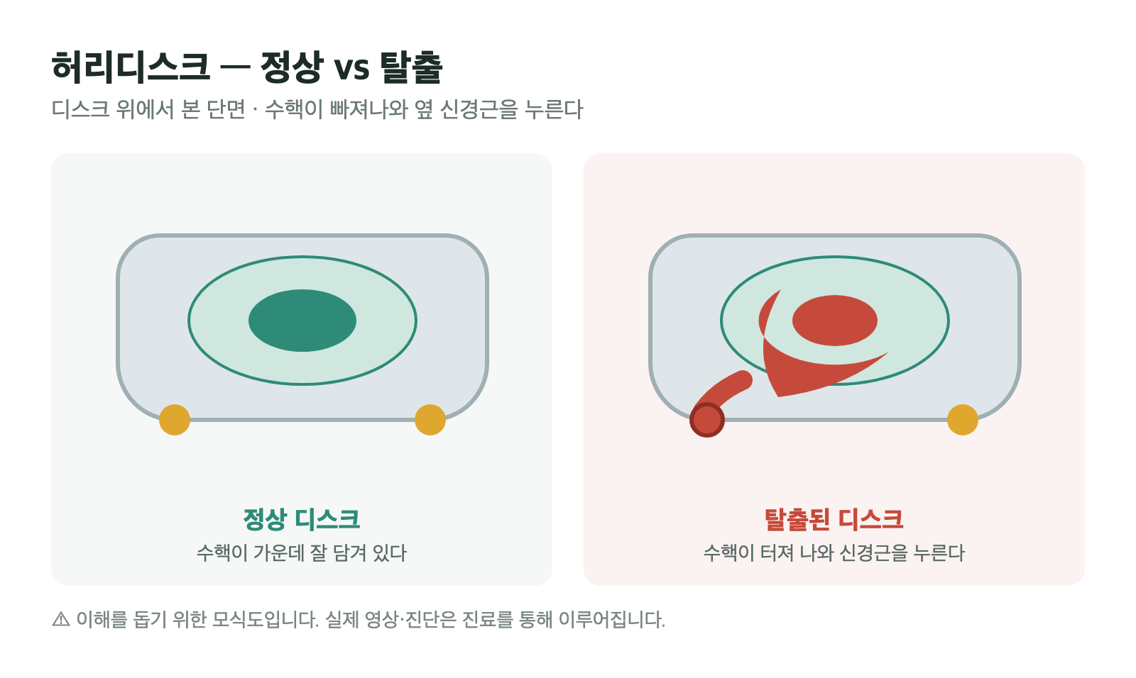 정상 디스크와, 수핵이 빠져나와 옆 신경근을 누르는 탈출된 디스크를 비교한 단면 모식도