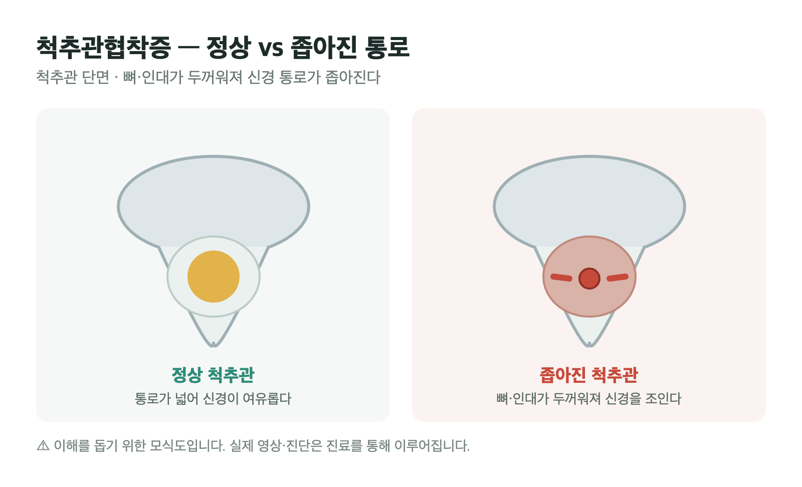 넓은 정상 척추관과, 뼈·인대가 두꺼워져 신경을 조이는 좁아진 척추관을 비교한 단면 모식도