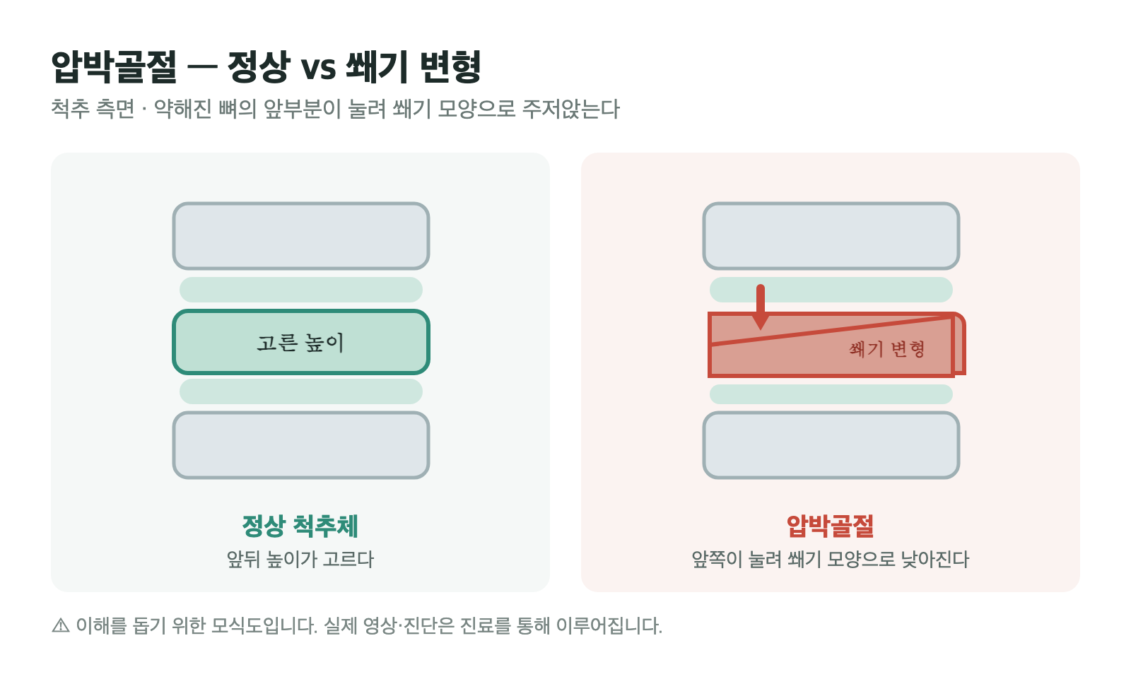 높이가 고른 정상 척추체와, 앞부분이 눌려 쐐기 모양으로 주저앉은 압박골절을 비교한 측면 모식도