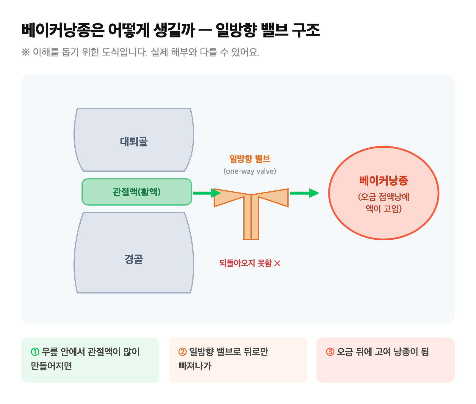 무릎 안의 관절액이 일방향 밸브를 통해 오금 뒤편 점액낭에 고여 베이커낭종이 만들어지는 과정 도식