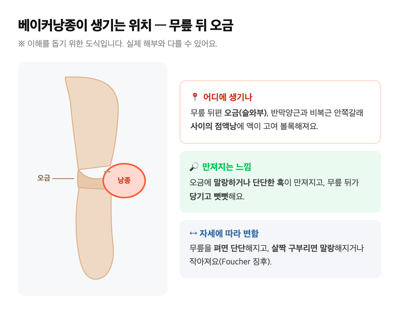 무릎 뒤 오금에 생긴 베이커낭종의 위치를 보여주는 모식도