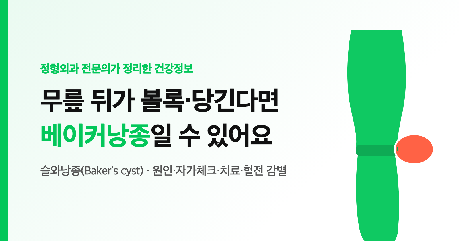 무릎 뒤가 볼록·당긴다면? 베이커낭종(슬와낭종) 원인·자가체크·치료, 종아리 부으면 혈전 감별까지 (전문의 정리)