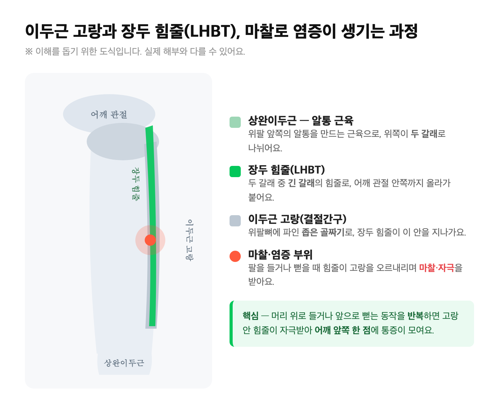 어깨 앞쪽 이두근 고랑과 이두근 장두 힘줄(LHBT)의 위치, 마찰로 염증이 생기는 과정을 단순화한 이해용 도식