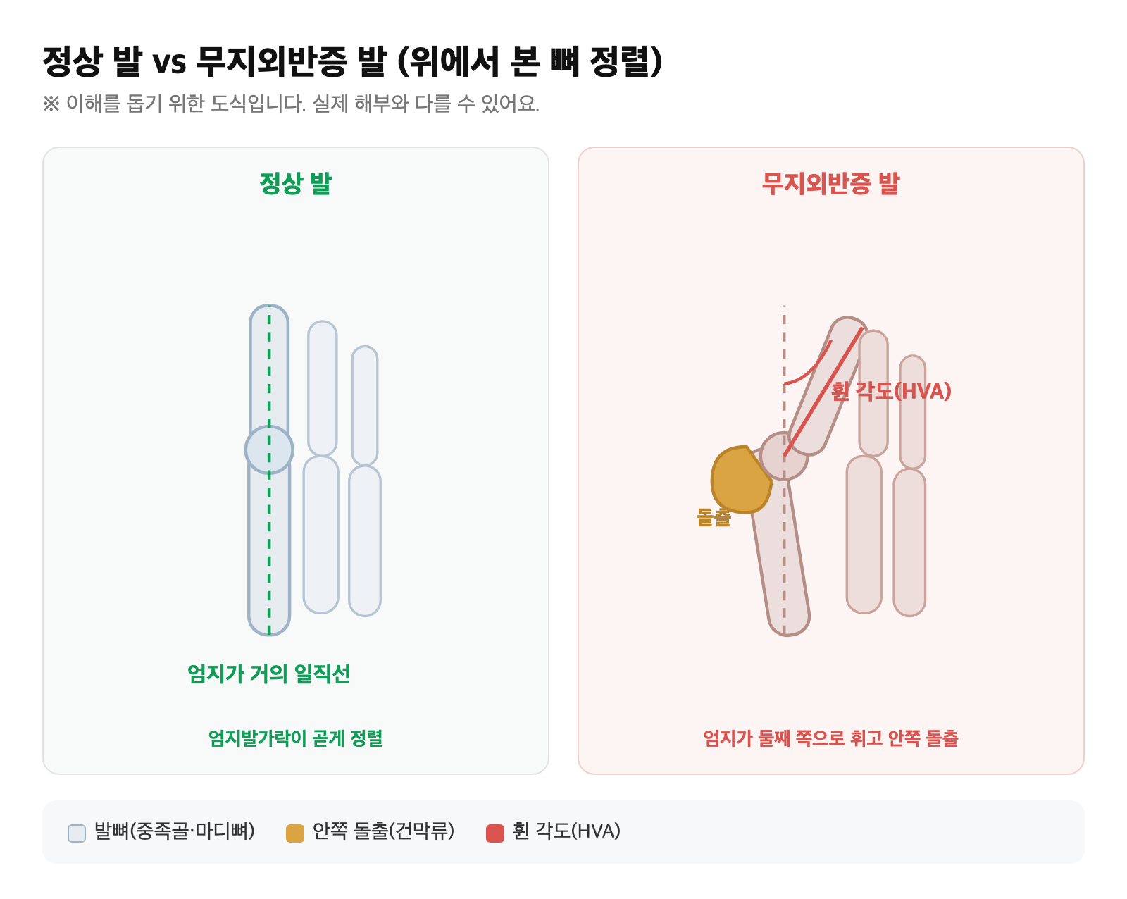 정상 발과, 엄지발가락이 둘째발가락 쪽으로 휘고 안쪽 관절이 튀어나온 무지외반증 발의 뼈 정렬을 비교한 도식