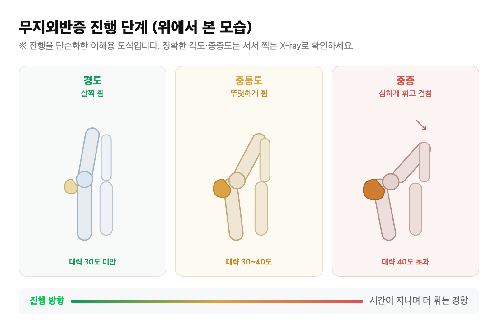 무지외반증 경도·중등도·중증으로 갈수록 엄지발가락이 더 휘고 둘째발가락과 겹쳐지는 진행 단계를 단순화한 도식
