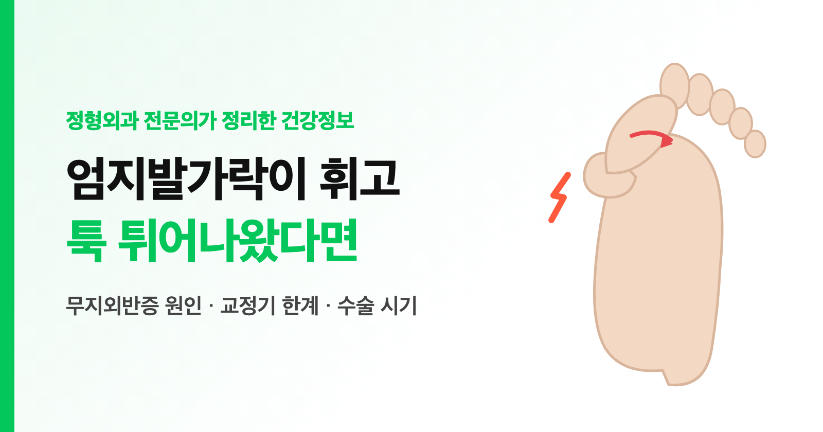 무지외반증 증상, 엄지발가락이 휘고 튀어나왔다면? 원인·교정기 한계·수술 시기 (여름 샌들철 정리)