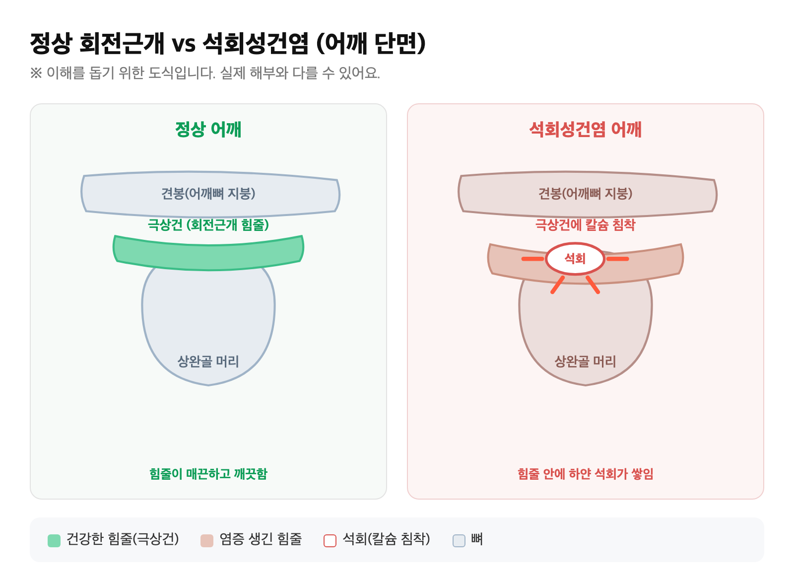 정상 어깨 회전근개 힘줄과, 극상건 안에 하얗게 칼슘(석회)이 침착된 석회성건염 어깨를 단순화해 비교한 도식