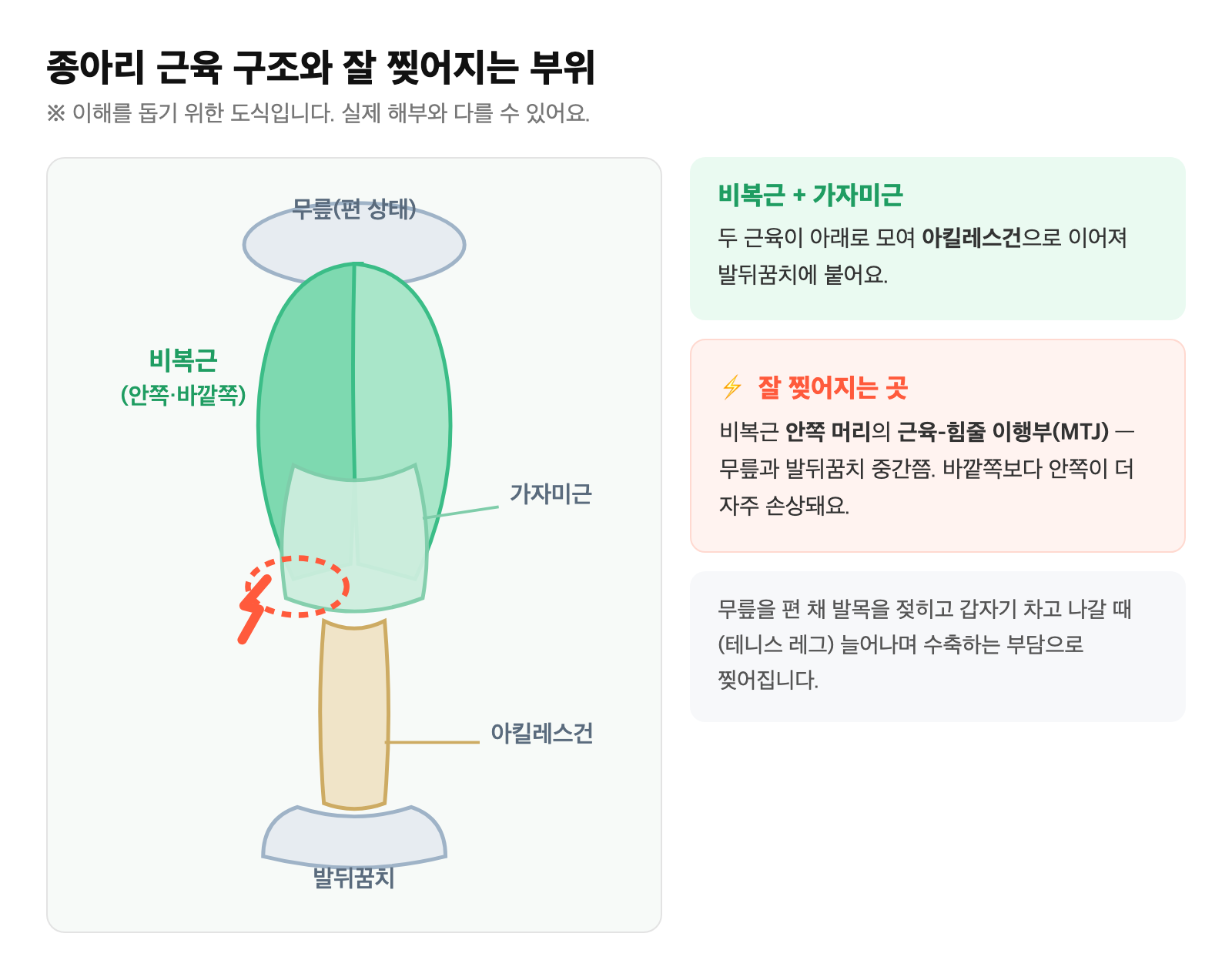 종아리 비복근·가자미근·아킬레스건의 해부 구조와, 테니스 레그가 잘 생기는 비복근 안쪽 머리의 근육-힘줄 이행부(MTJ) 손상 부위를 표시한 도식