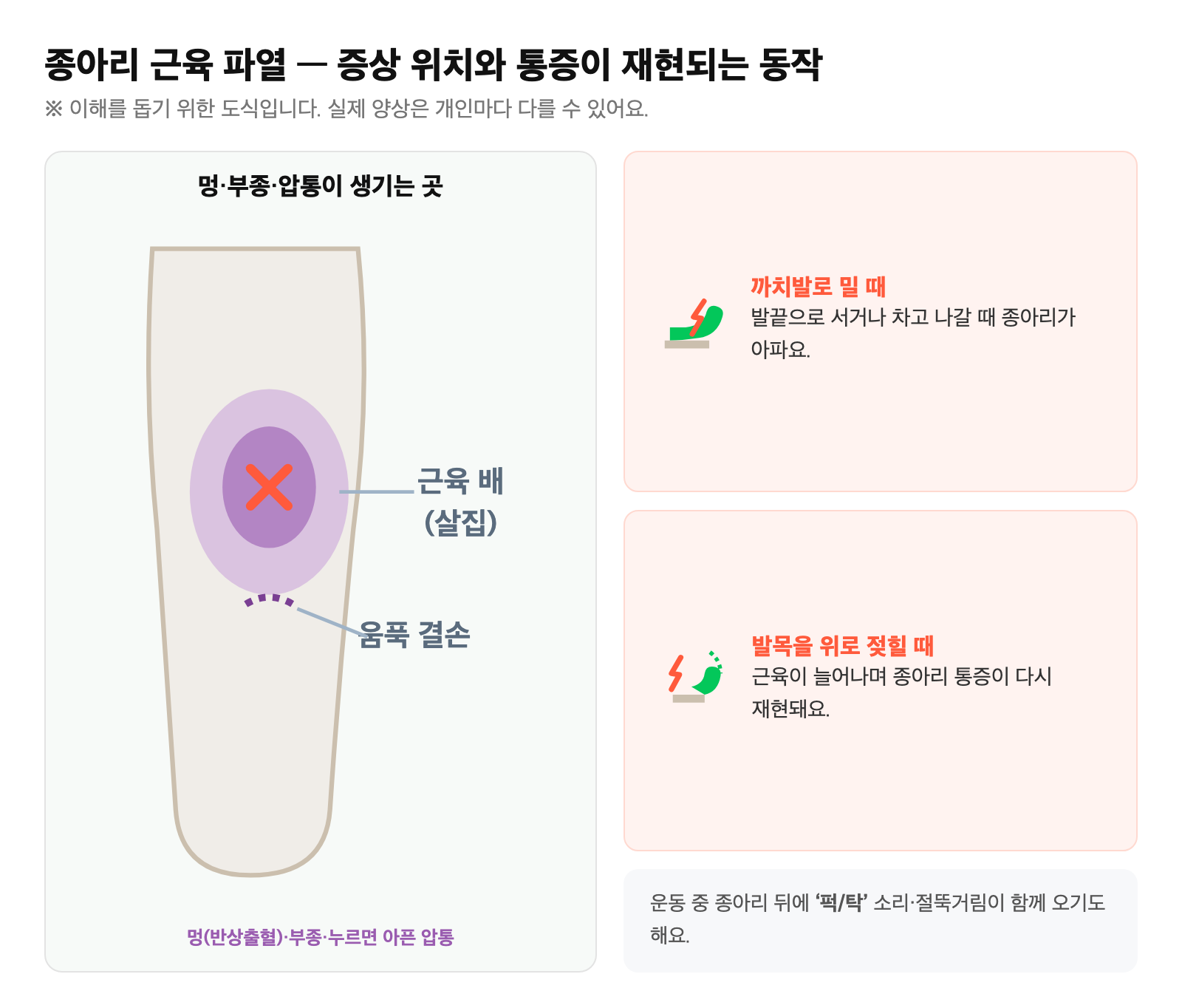 종아리 근육 파열 시 멍·부종·압통이 나타나는 종아리 살집(근육 배) 위치와, 까치발로 밀거나 발목을 위로 젖힐 때 통증이 재현되는 모습을 단순화한 그림