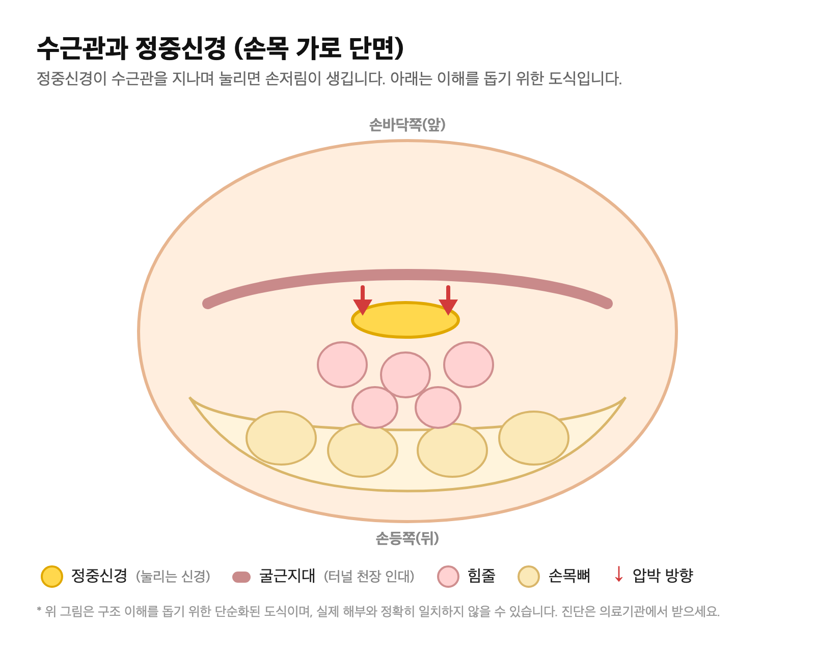 수근관과 정중신경 손목 가로 단면 도식 — 굴근지대 아래에서 정중신경이 눌리는 위치