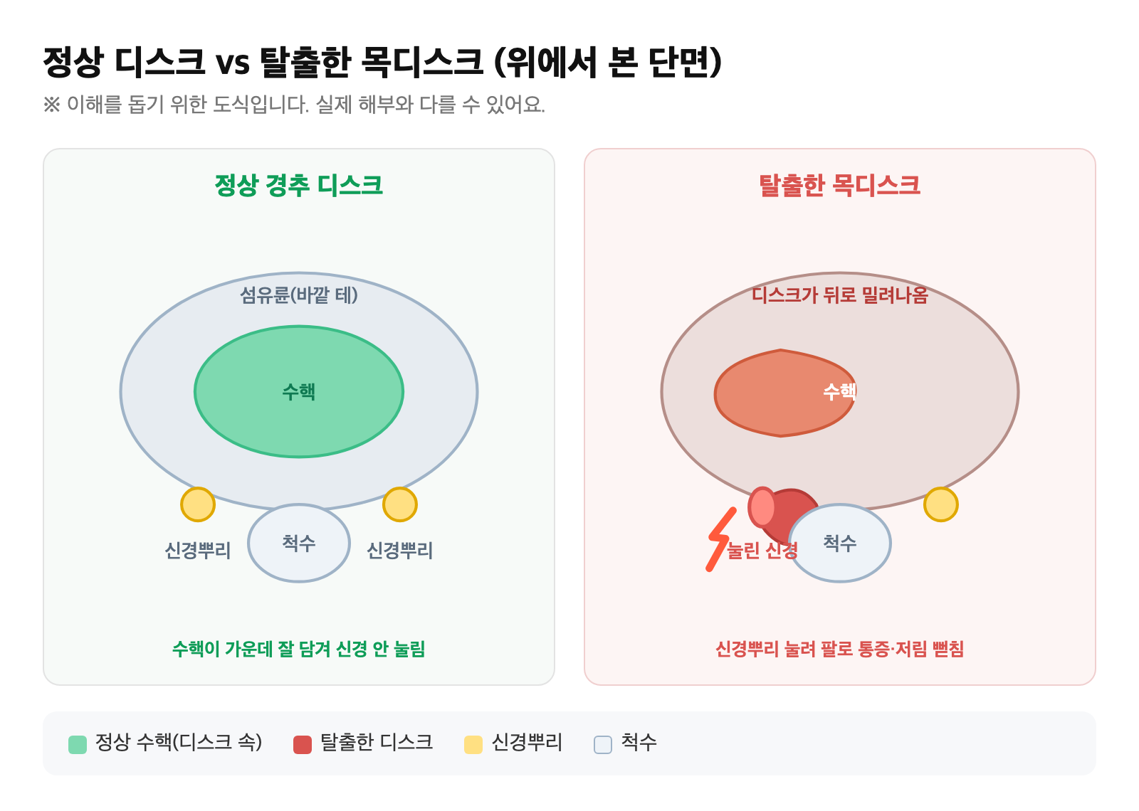 정상 경추 디스크와, 뒤로 탈출한 디스크가 옆을 지나는 신경뿌리를 누르는 모습을 비교한 단면 도식