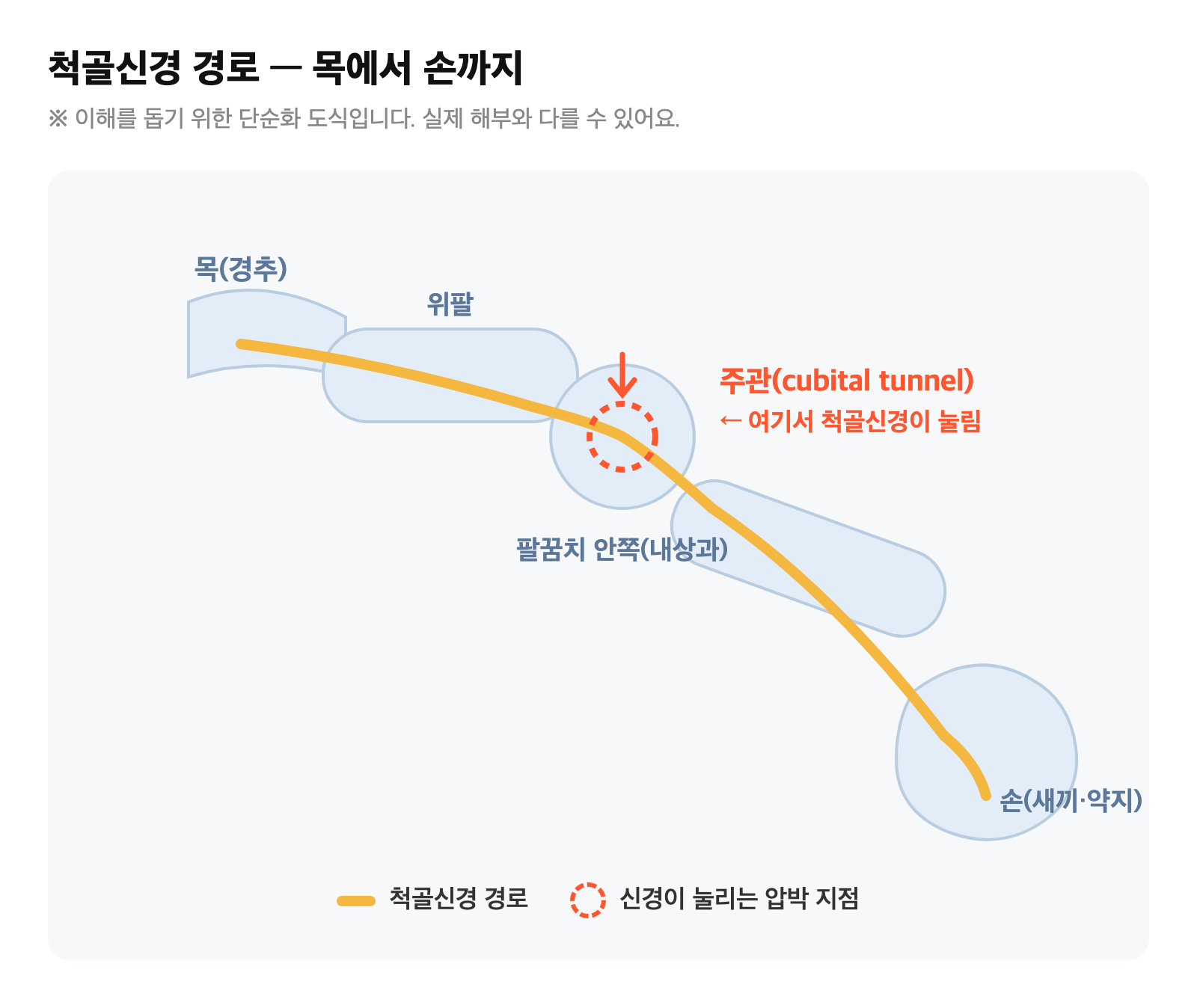 척골신경이 목에서 출발해 팔꿈치 안쪽 주관(내상과 뒤)을 지나 손까지 가는 경로와 주관에서 신경이 눌리는 압박 지점을 표시한 단순화 도식