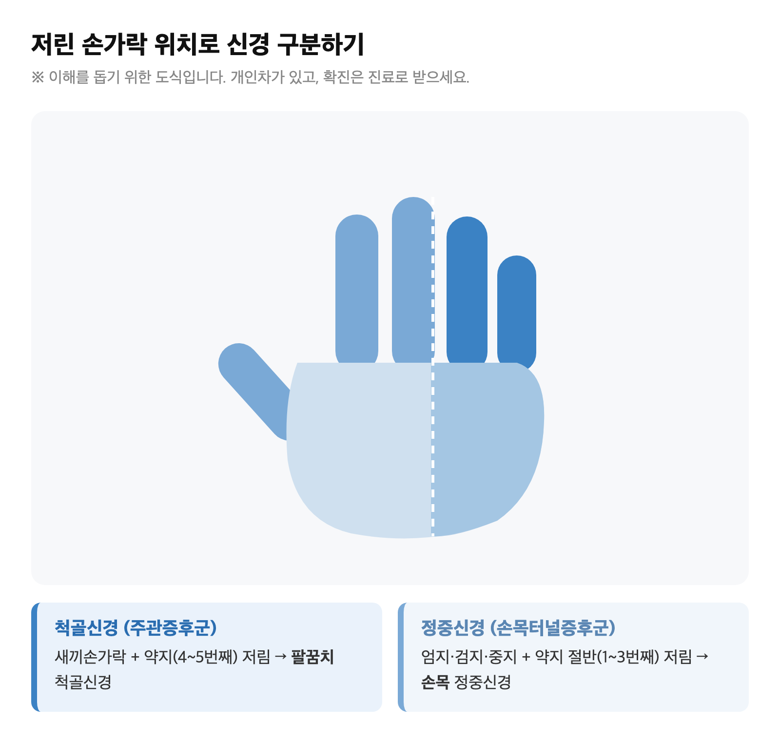 손 그림 위에 척골신경 지배 영역(새끼손가락·약지)과 정중신경 지배 영역(엄지·검지·중지·약지 절반)을 다른 색으로 칠해 저린 손가락 위치를 비교한 도식