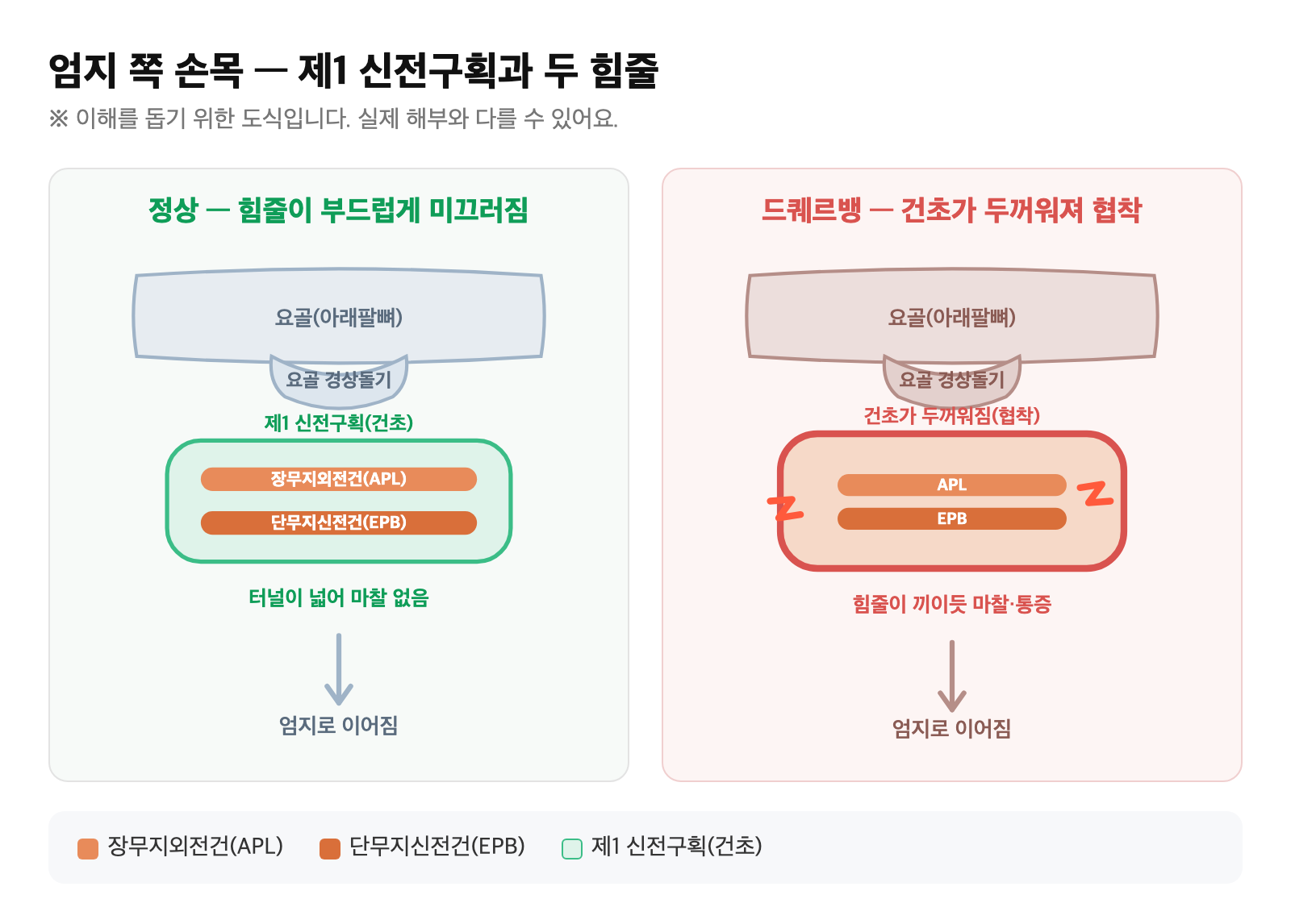 엄지 쪽 손목의 제1 신전구획을 지나는 장무지외전건과 단무지신전건, 그리고 터널이 좁아져 마찰이 생기는 과정을 단순화한 도식