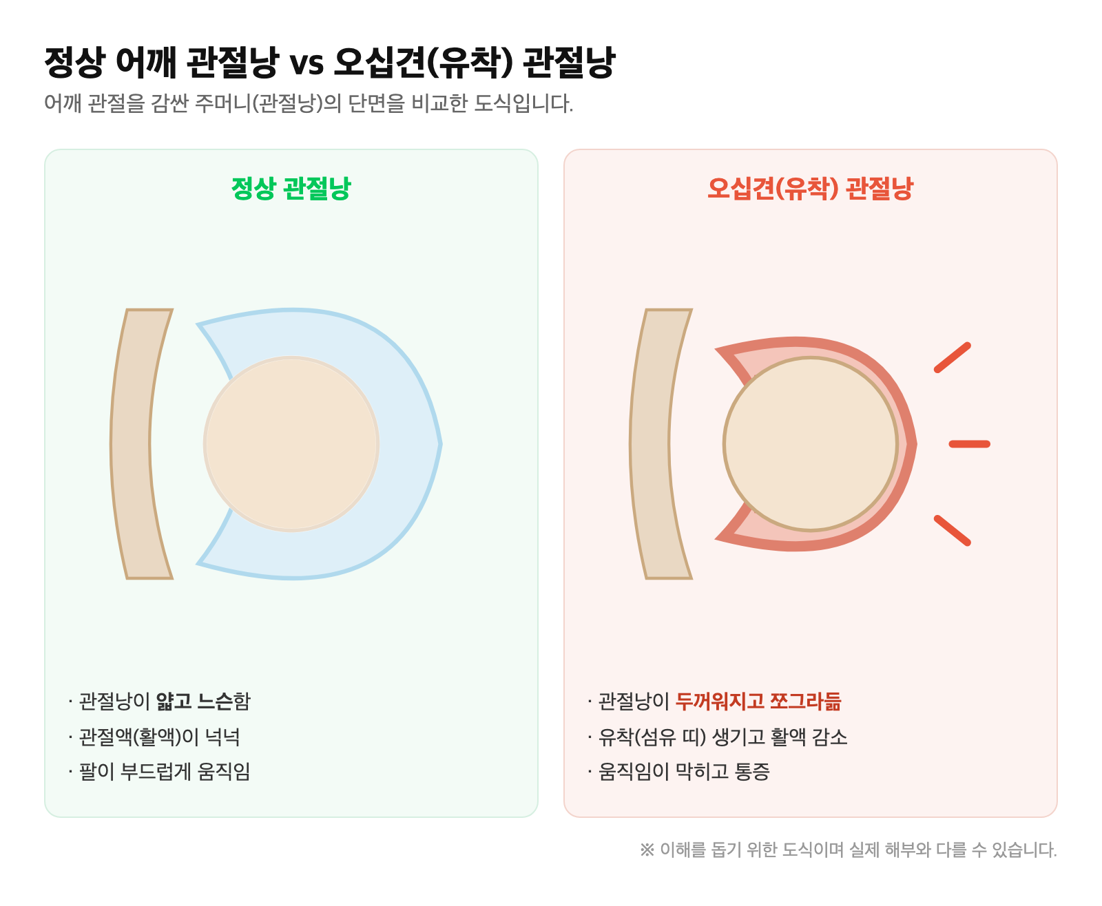 정상 어깨 관절낭과 오십견(유착) 관절낭을 비교한 단면 도식