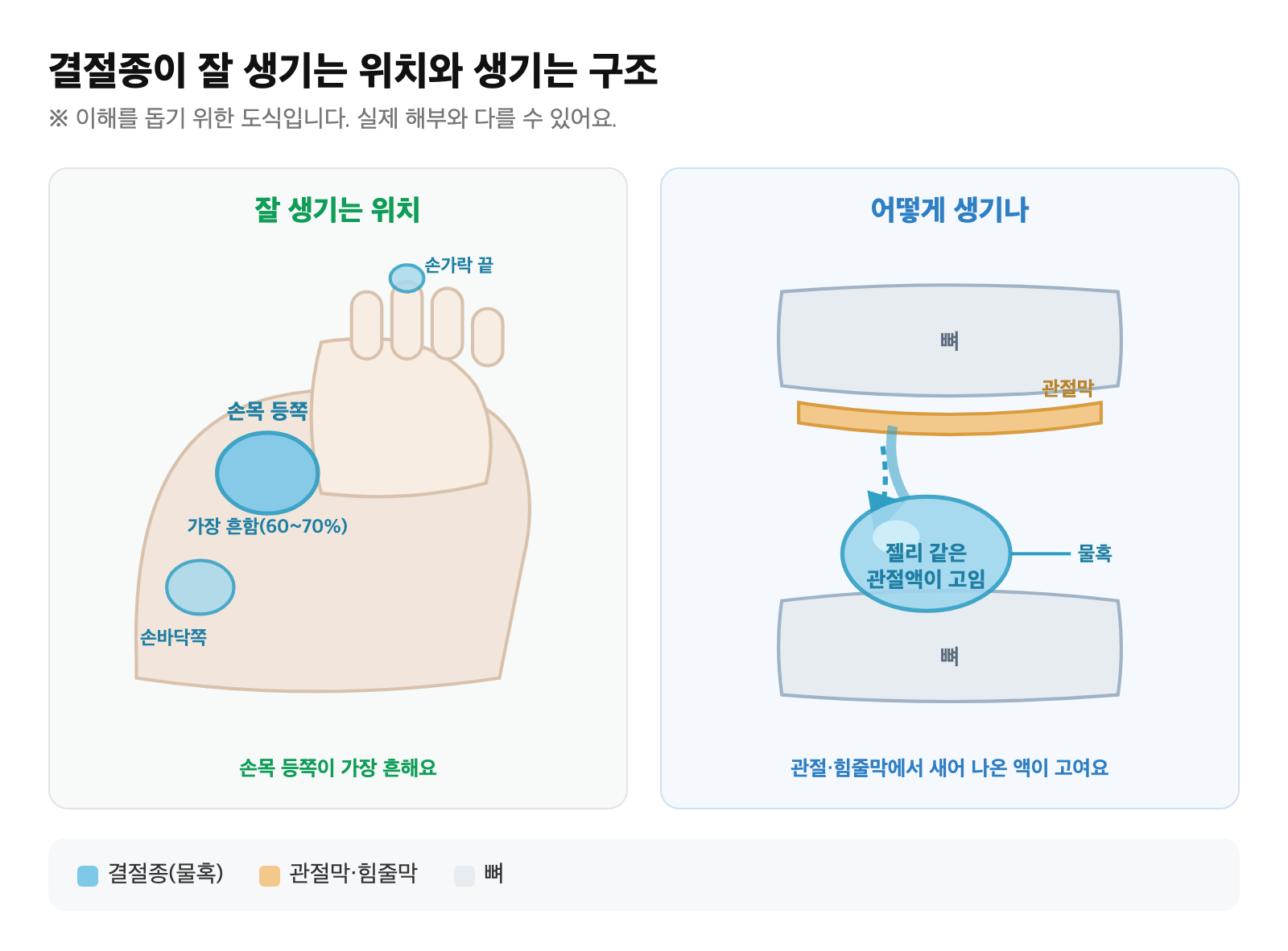 손목 등쪽과 손바닥쪽에 결절종이 생기는 위치를 표시하고, 관절·힘줄막에서 새어 나온 관절액이 주머니에 고인 모습을 단순화한 도식