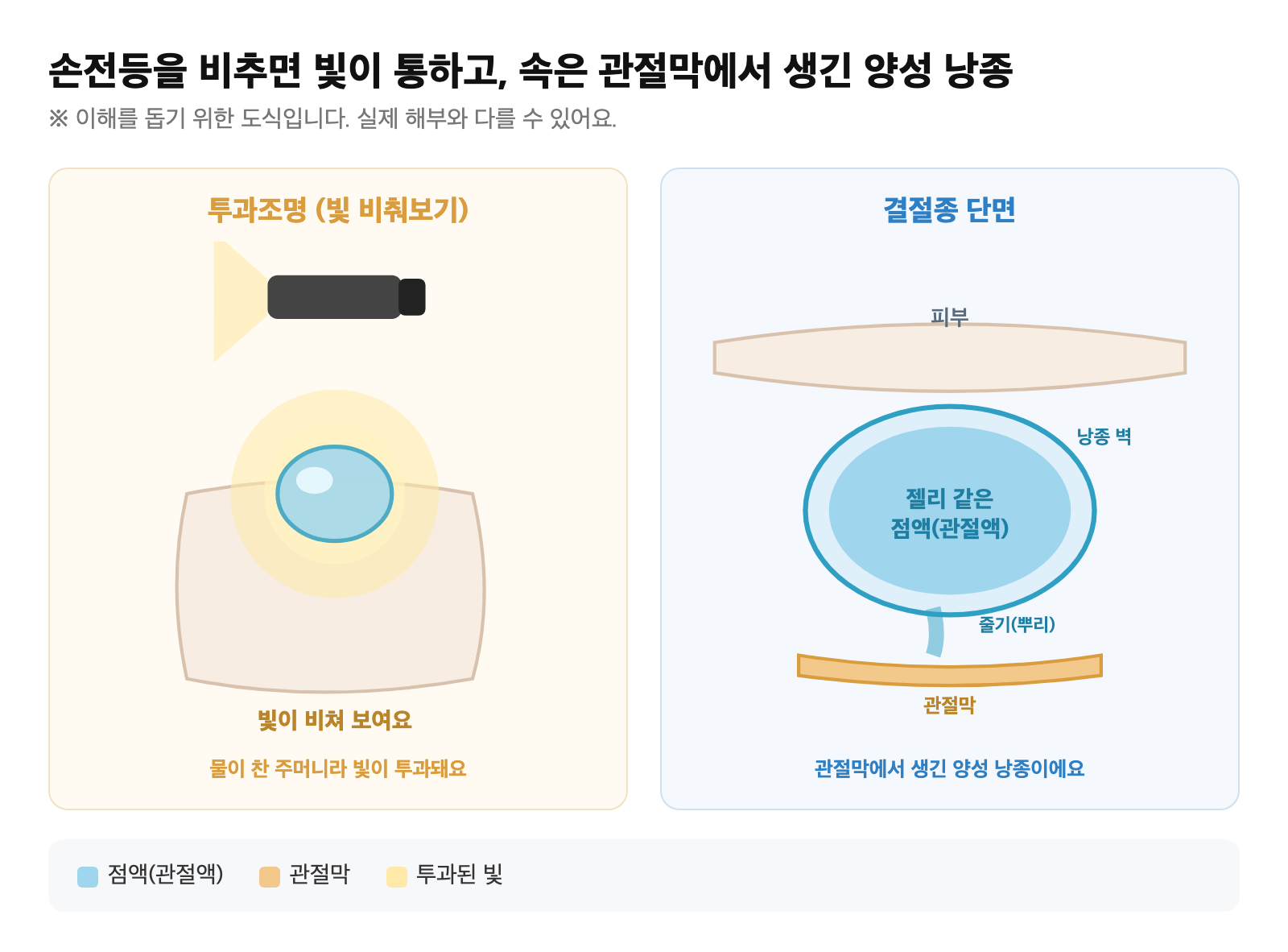 어두운 곳에서 손전등을 비추면 결절종에 빛이 투과되는 모습과, 정상 손목 대비 물혹 단면을 단순화한 도식