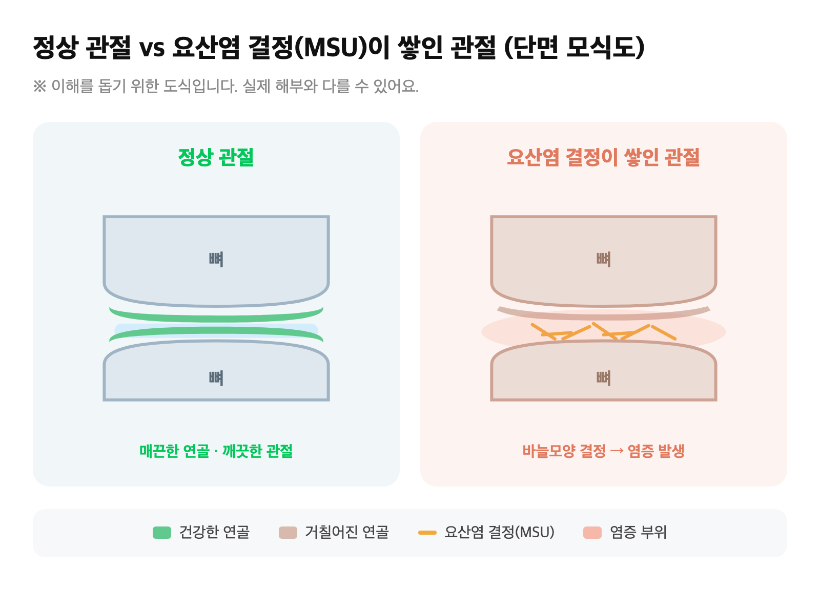 정상 관절과 요산염 결정(MSU)이 쌓여 염증이 생긴 관절 단면을 비교한 도식
