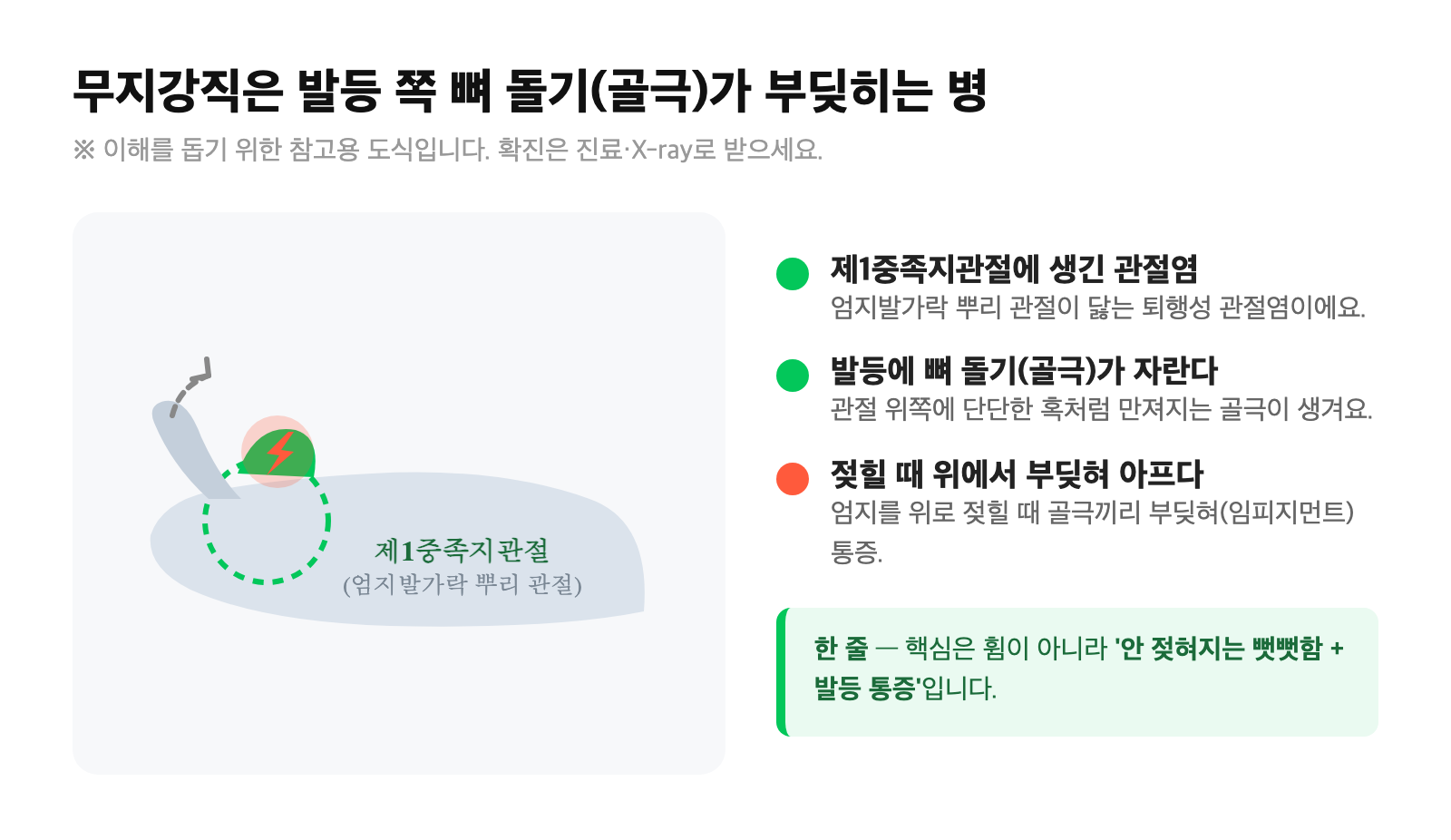발 옆모습 도식 — 제1중족지관절 위치와 발등 골극이 부딪히는 모습