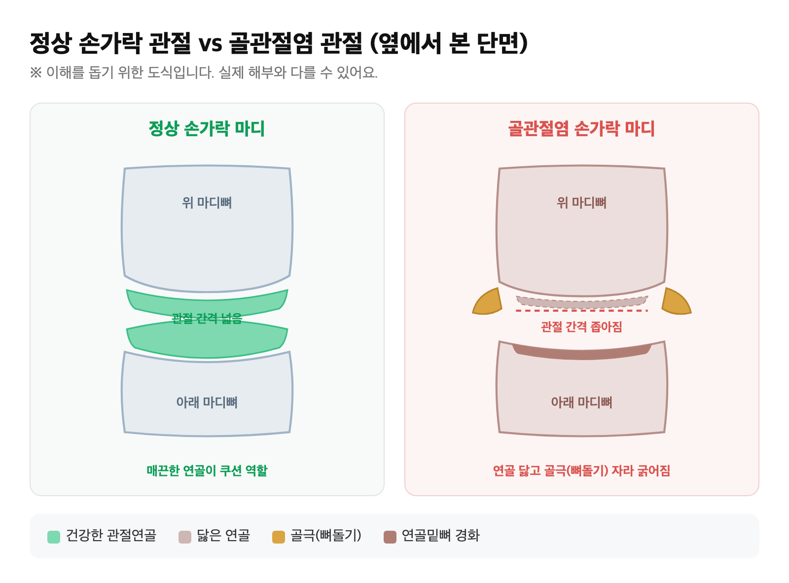 정상 손가락 관절과 연골이 닳고 골극(뼈돌기)이 자라 마디가 굵어진 골관절염 관절의 단면 비교 도식