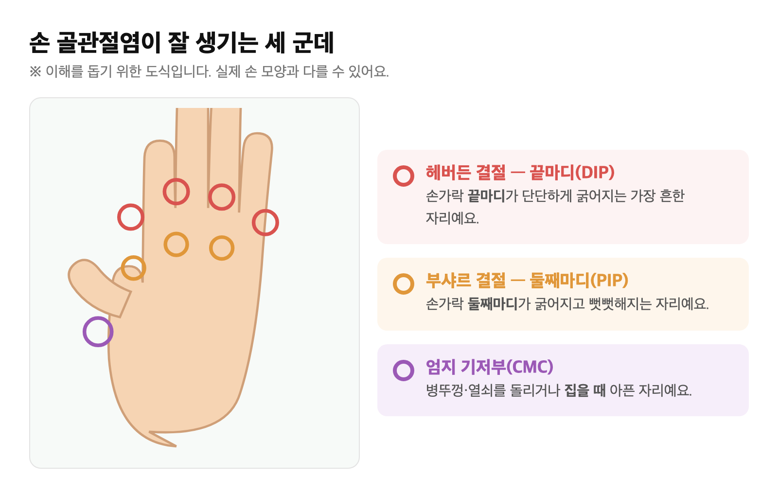 손 그림 위에 헤버든 결절(끝마디)·부샤르 결절(둘째마디)·엄지 기저부 통증 위치를 표시한 도식
