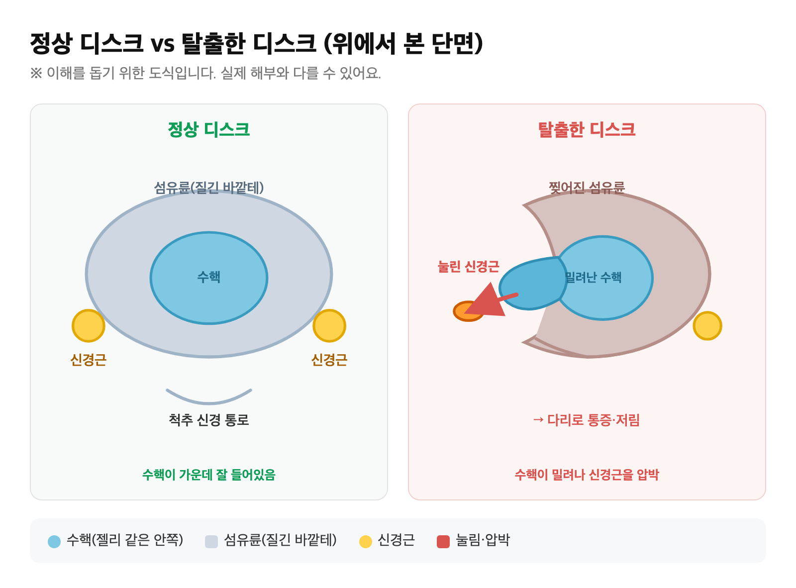 정상 추간판과 수핵이 섬유륜을 뚫고 탈출해 옆의 신경근을 누르는 모습을 비교한 도식 — 허리디스크 발생 메커니즘
