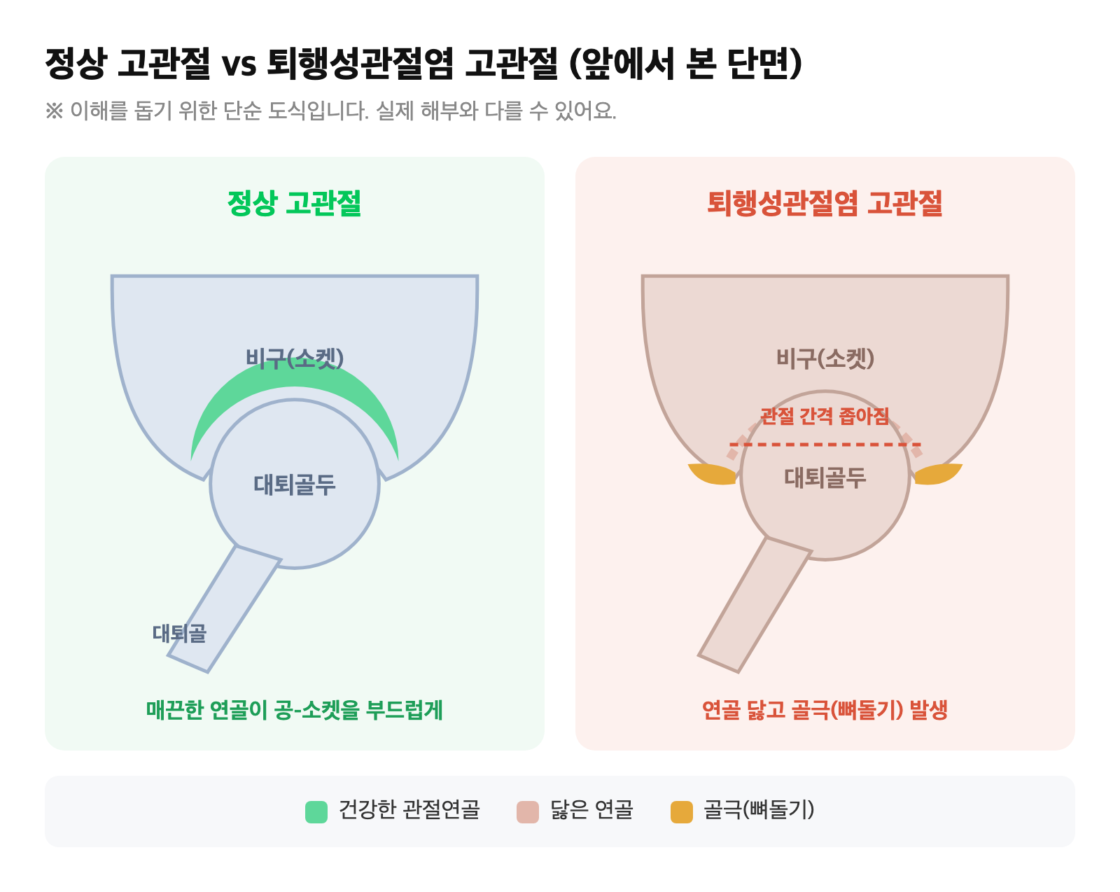 정상 고관절과 연골이 닳아 관절 간격이 좁아지고 골극이 생긴 퇴행성관절염 고관절(공-소켓 구조)의 단면을 비교한 도식