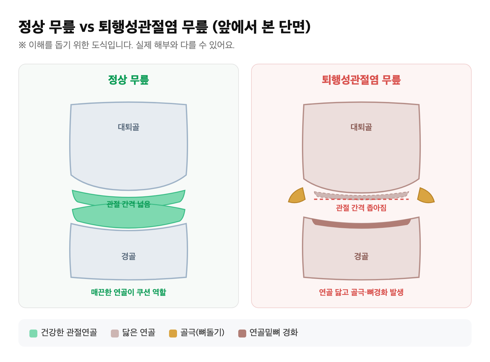 정상 무릎 관절과 연골이 닳아 관절 간격이 좁아지고 골극이 생긴 퇴행성관절염 무릎의 단면을 비교한 도식
