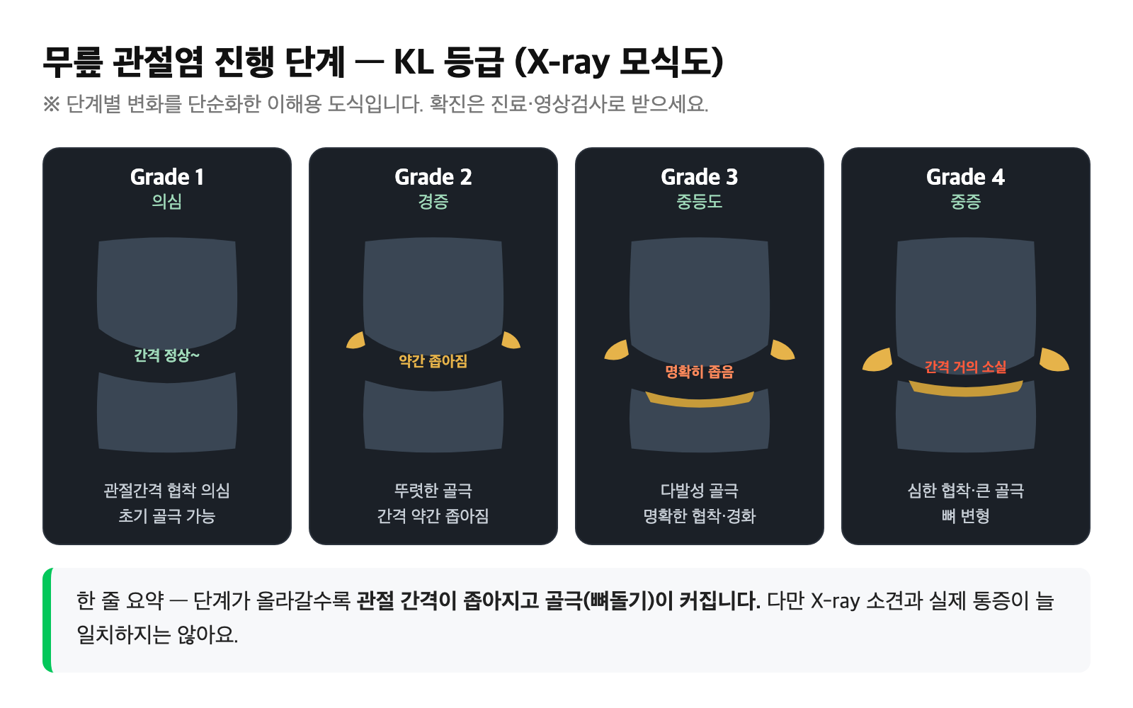 무릎 관절염 KL 1~4단계별로 관절 간격이 좁아지고 골극이 커지는 변화를 단순화한 X-ray 모식도