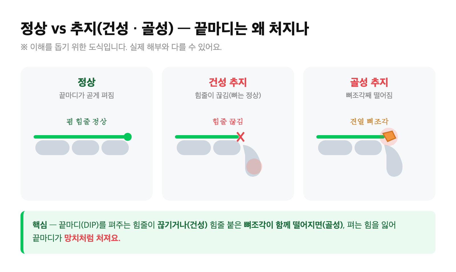 정상 손가락과 건성 추지·골성 추지에서 끝마디 폄 힘줄이 끊기거나 뼈조각이 떨어져 끝마디가 처진 모습을 비교한 도식