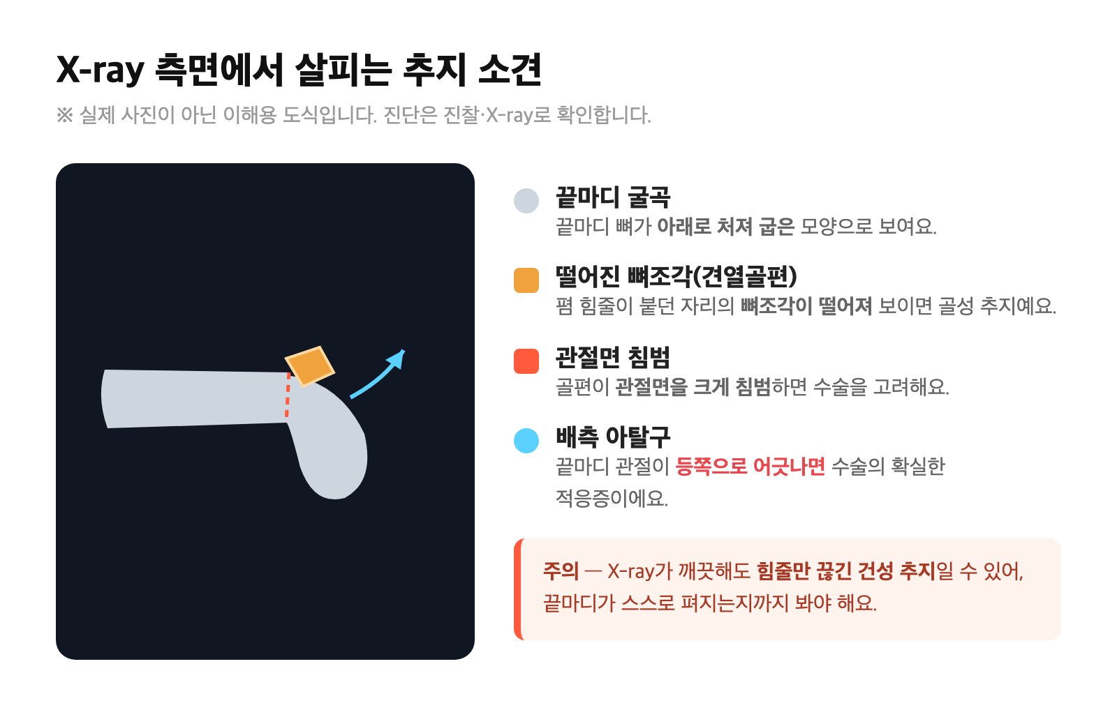 추지 X-ray 측면에서 끝마디 굴곡, 신전건 부착부의 떨어진 뼈조각(견열골편), 관절면 침범, 배측 아탈구 소견을 표시한 이해용 도식
