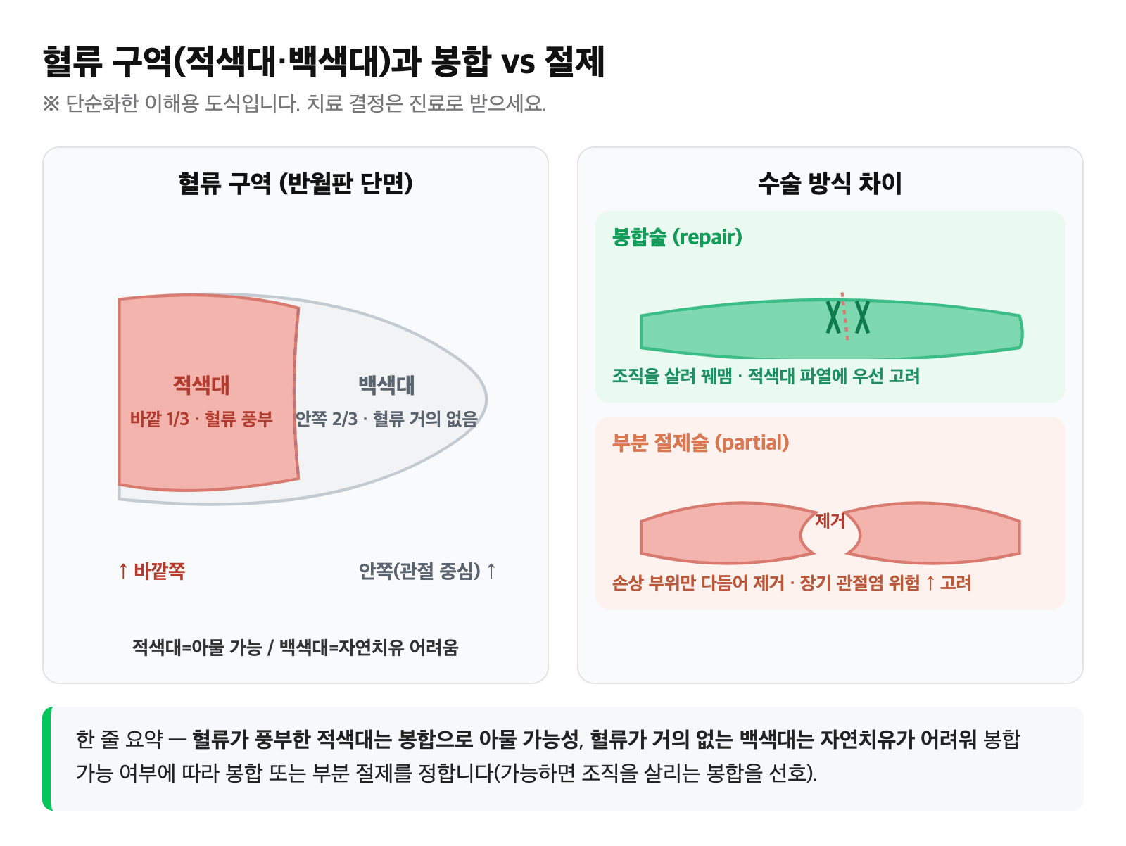 무릎 반월상연골의 적색대·백색대 혈류 구역과 봉합 vs 부분 절제 차이를 단순화한 도식