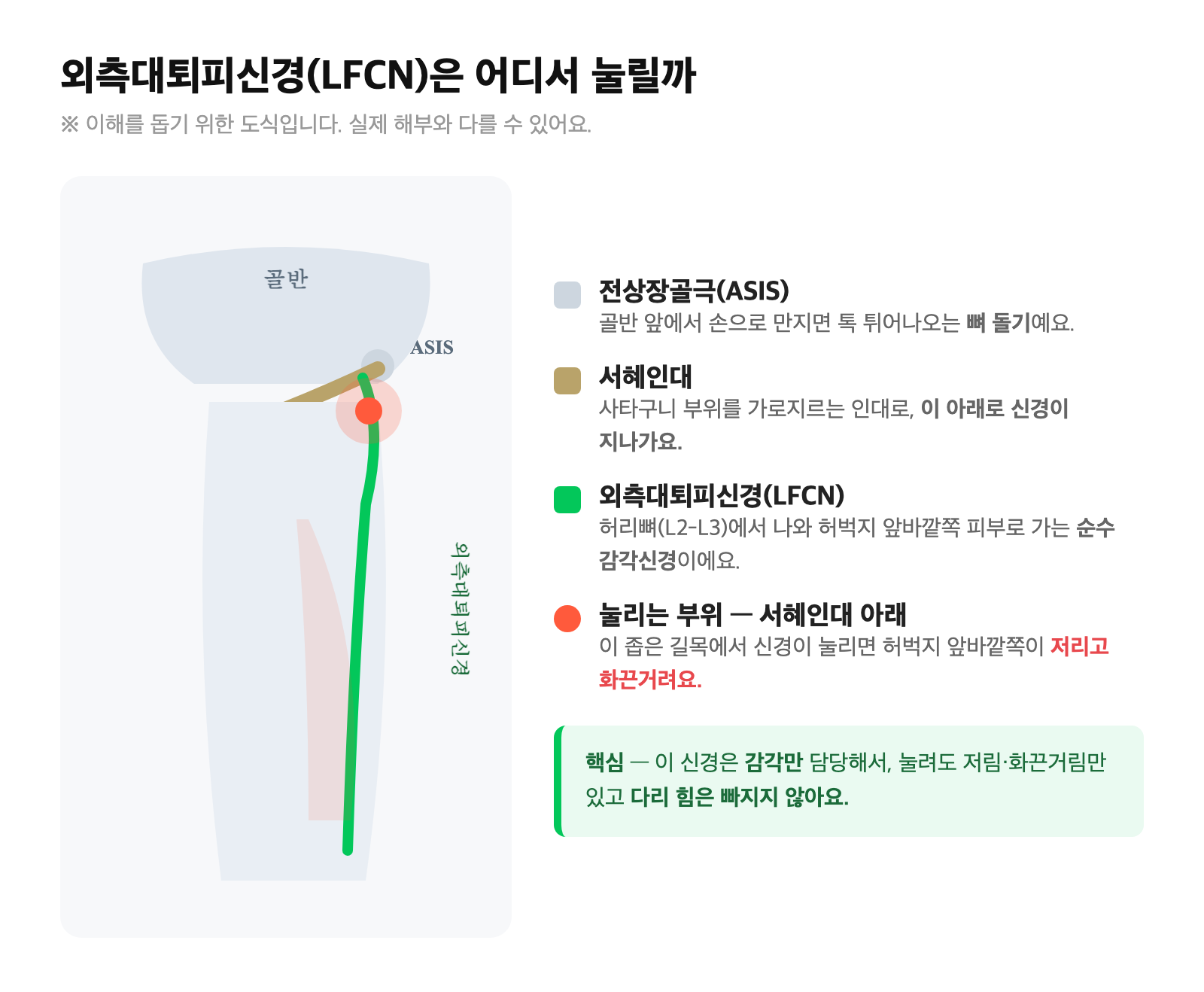 전상장골극(ASIS)과 서혜인대 아래를 지나는 외측대퇴피신경(LFCN)의 주행과 눌리는 부위를 표시한 해부 도식