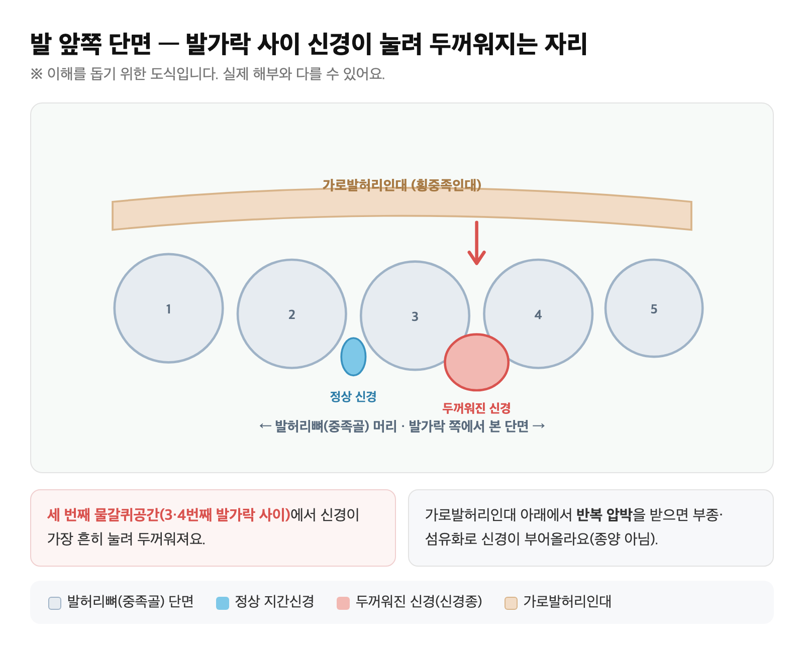 발 앞쪽 단면 도식 — 발허리뼈(중족골)들 사이를 지나는 지간신경이 가로발허리인대 아래에서 눌려 두꺼워진 모습