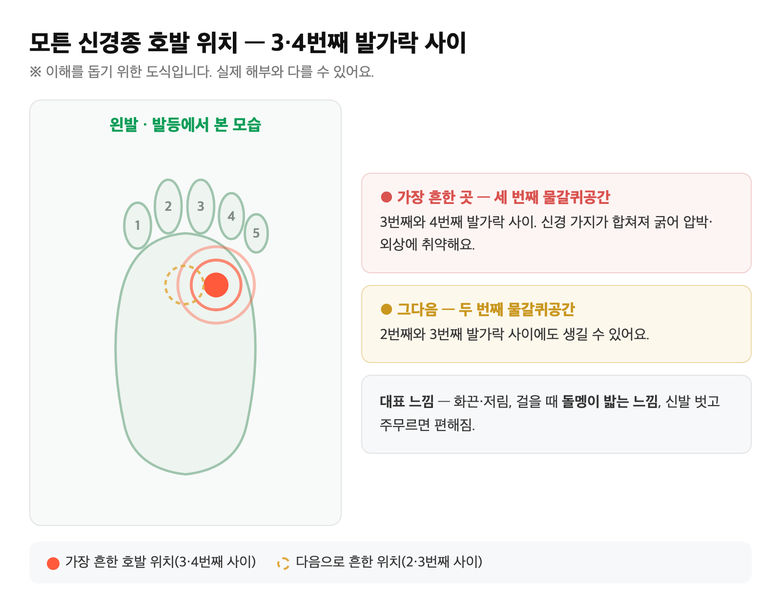 발등에서 본 발 그림 — 3~4번째 발가락 사이(세 번째 물갈퀴공간) 호발 위치에 통증·저림 표시