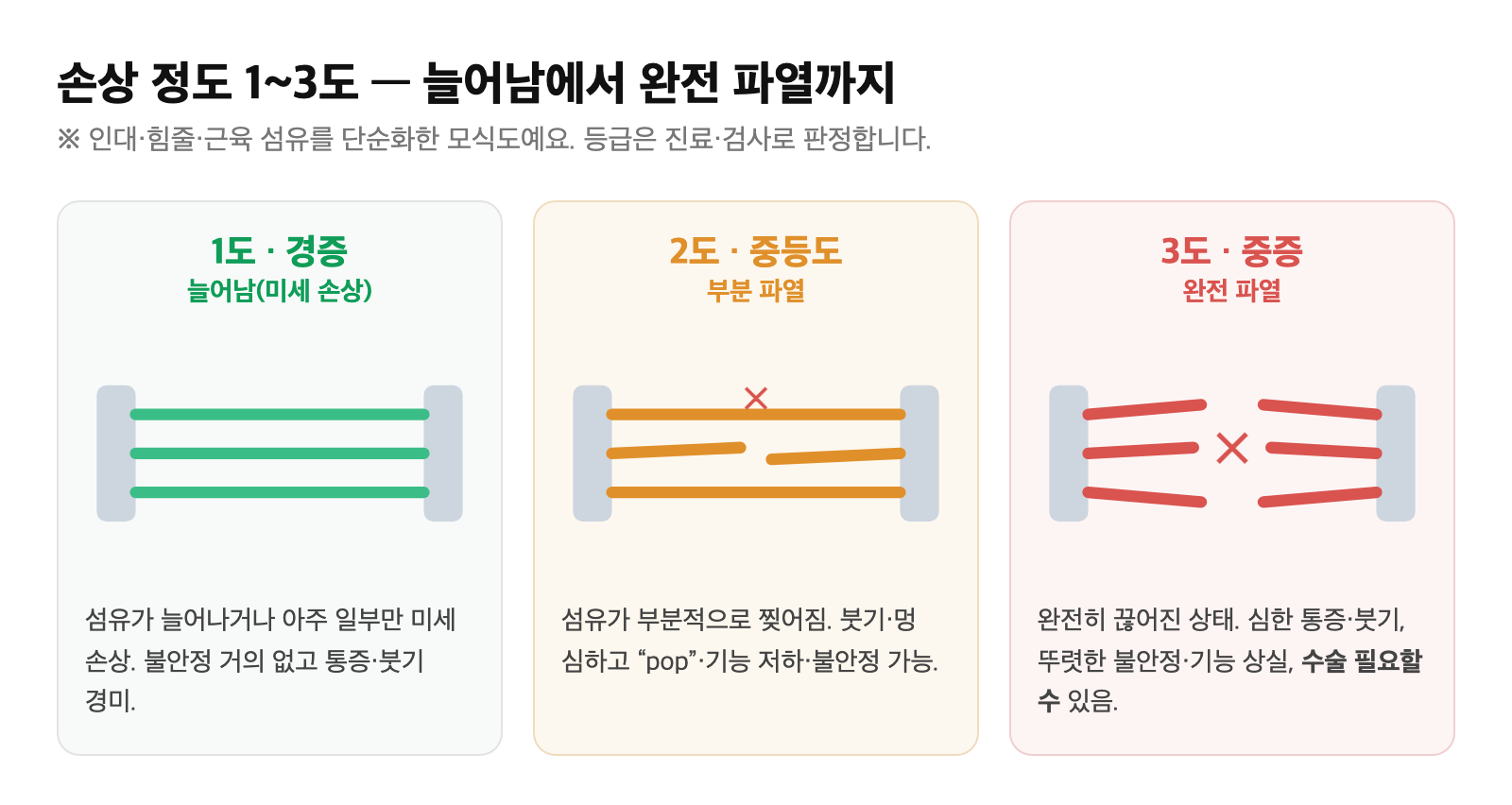 1도 늘어남에서 2도 부분 파열, 3도 완전 파열로 진행하는 연조직 손상 정도를 섬유 모식도로 단순화한 도식