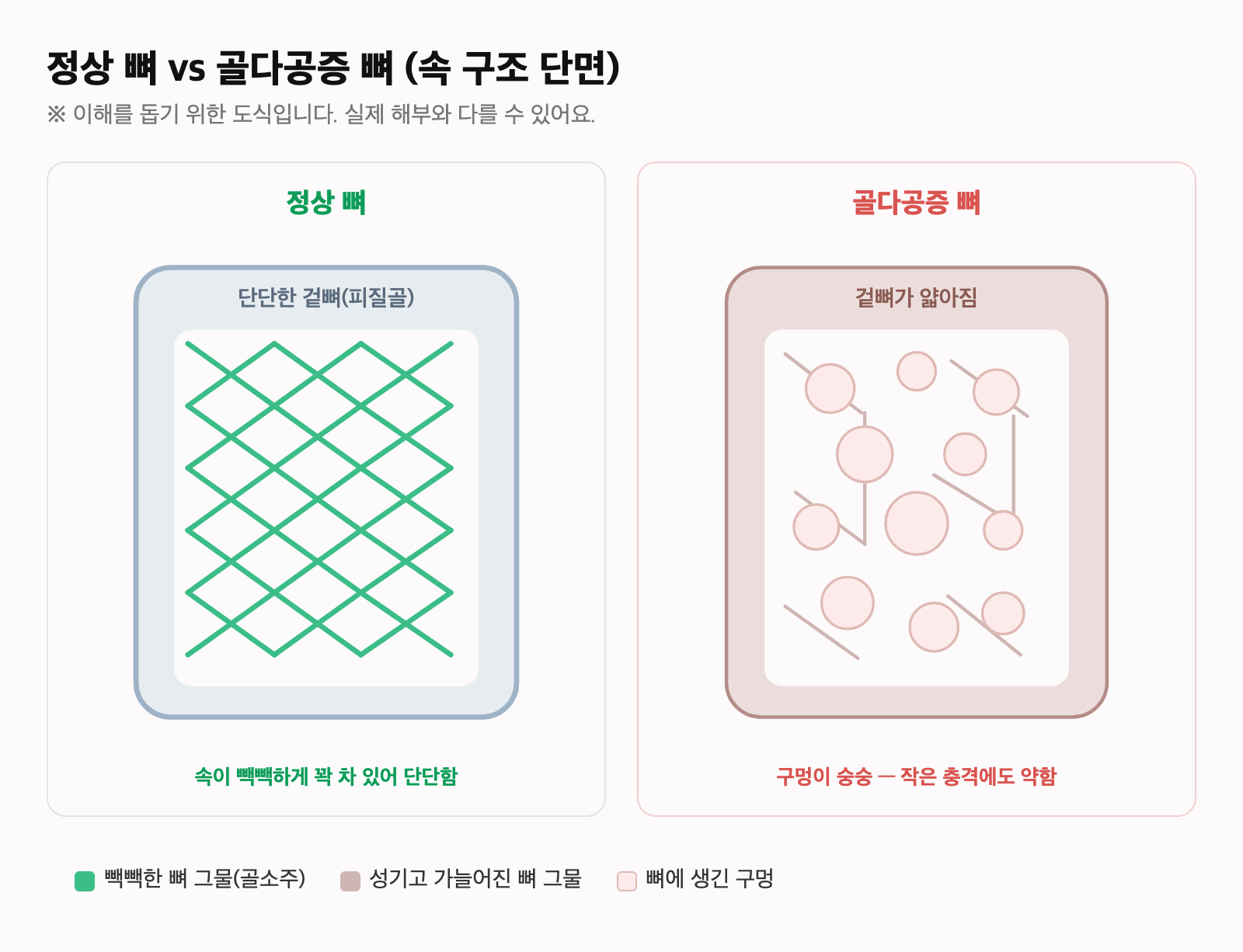속이 꽉 찬 정상 뼈와, 구멍이 많이 뚫려 약해진 골다공증 뼈의 단면을 비교한 도식
