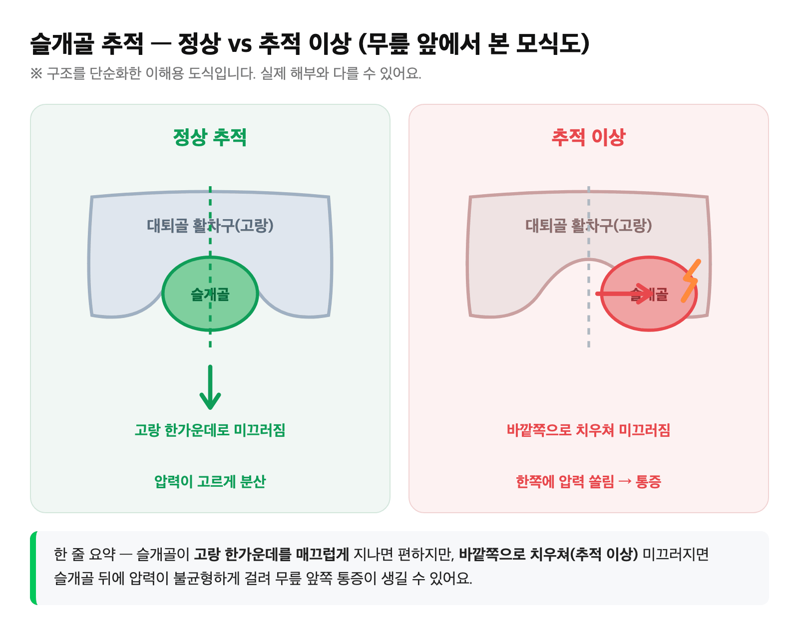 슬개골이 대퇴골 고랑을 따라 미끄러지는 모습 — 정상(가운데) vs 바깥쪽으로 치우친 추적 이상 비교 도식