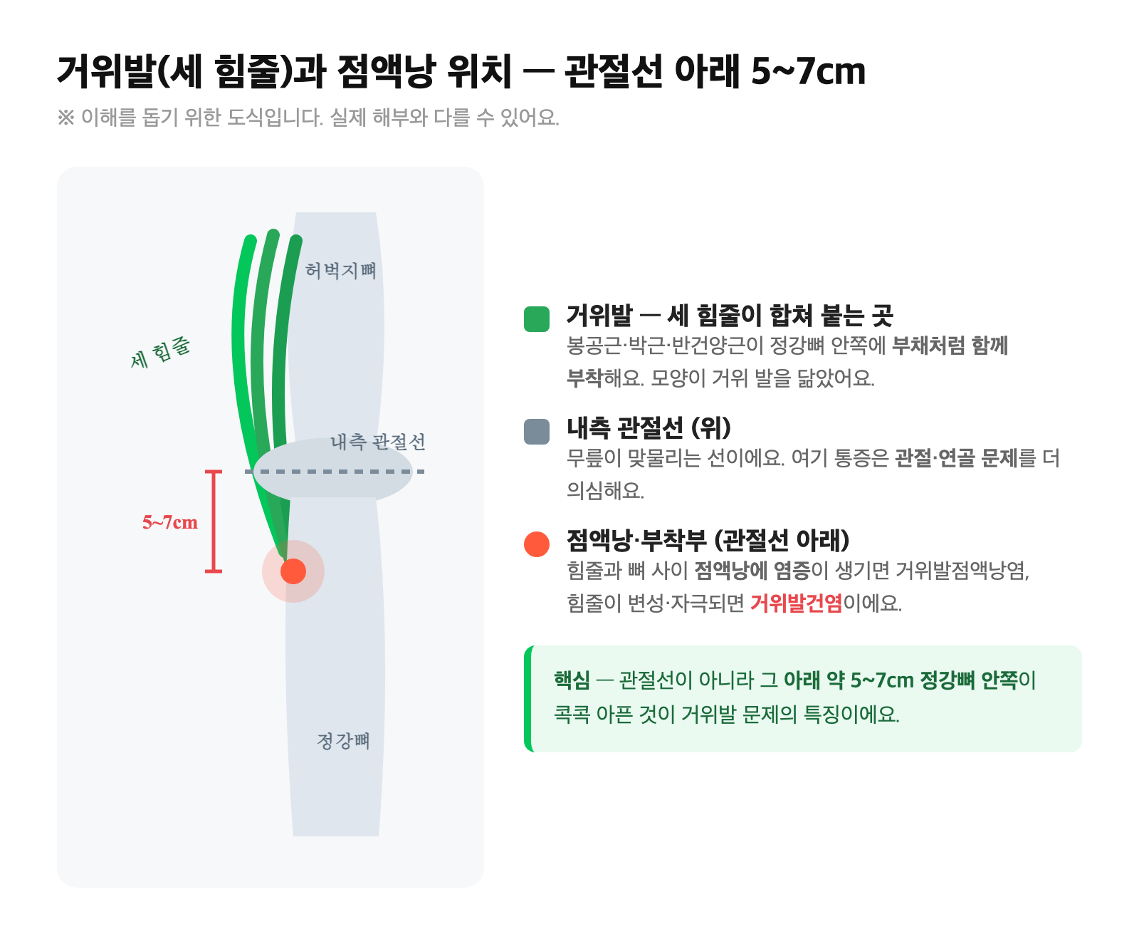 거위발(봉공근·박근·반건양근 세 힘줄)이 정강뼈 안쪽에 합쳐 붙는 부위와 점액낭 위치, 내측 관절선과 그 아래 약 5~7cm 거위발 부착부를 구분 표시한 도식
