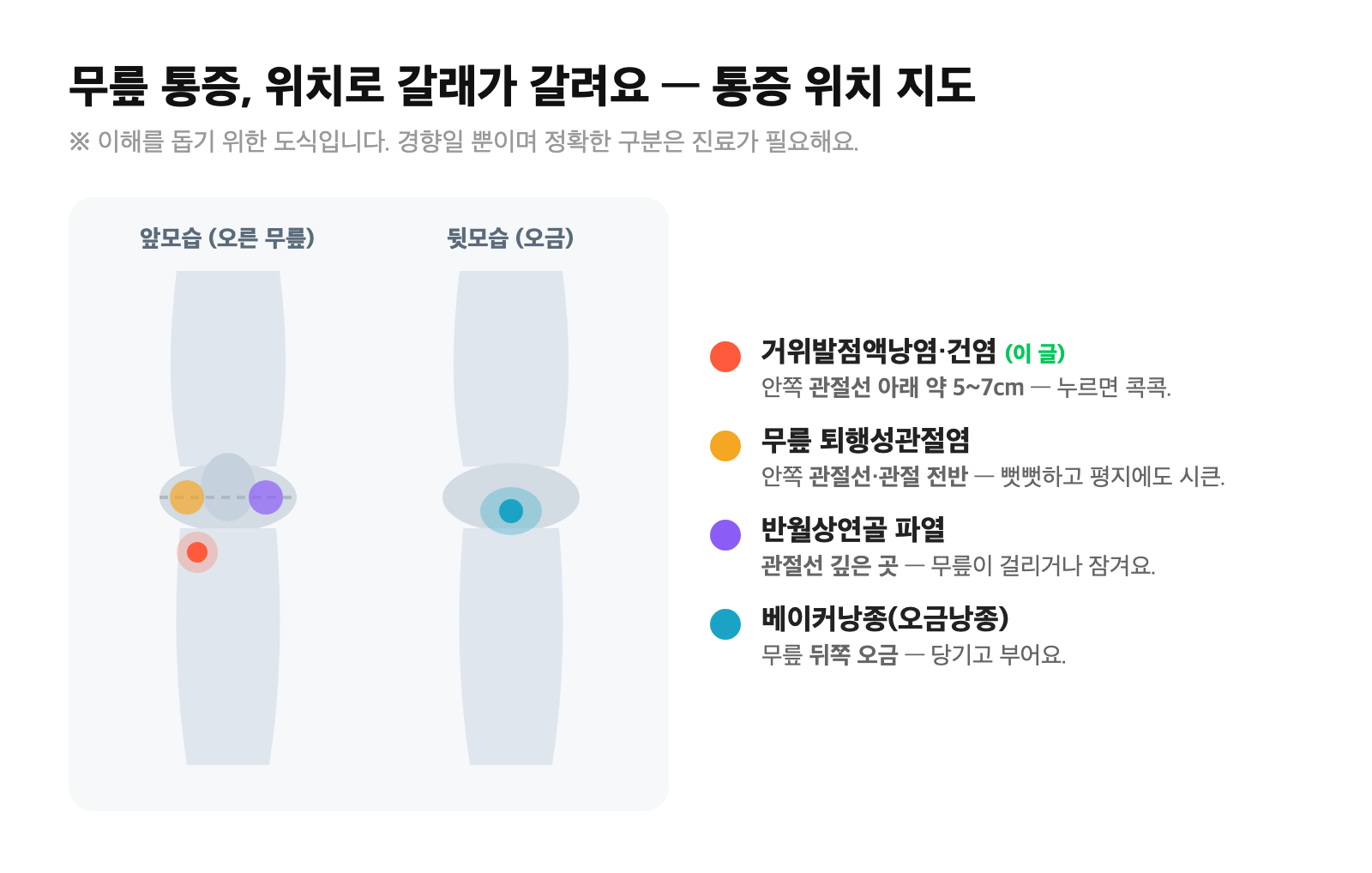 무릎 통증 위치 지도 — 안쪽 관절선 아래(거위발), 안쪽 관절선·전반(관절염), 관절선 깊은 곳(반월상연골), 뒤쪽 오금(베이커낭종)을 무릎 앞·뒤 그림 위에 표시한 비교 도식