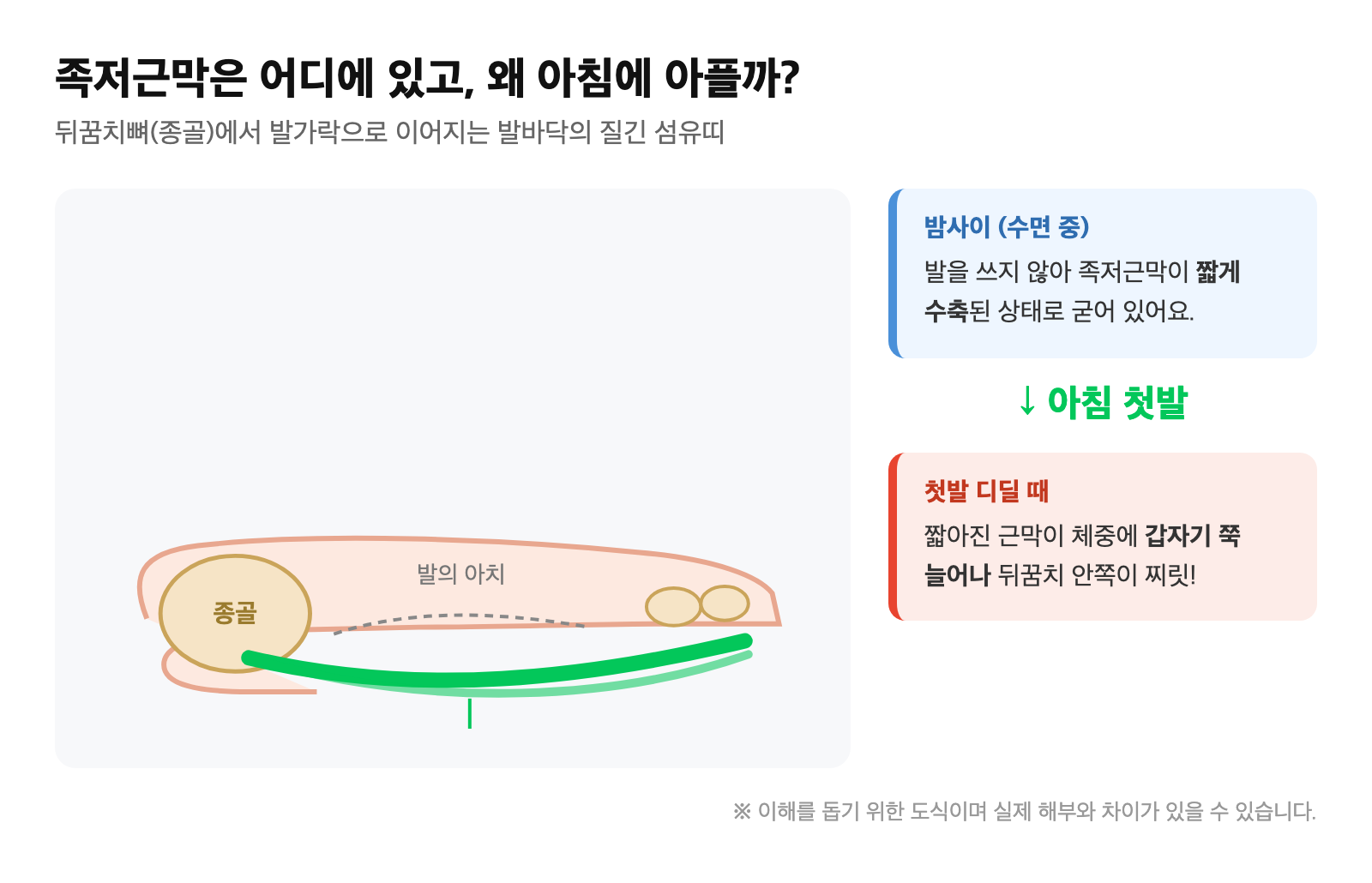 종골(뒤꿈치뼈)에서 발가락으로 이어지는 족저근막의 위치와, 밤사이 수축됐다가 아침 첫발에 갑자기 늘어나며 통증이 생기는 메커니즘 도식