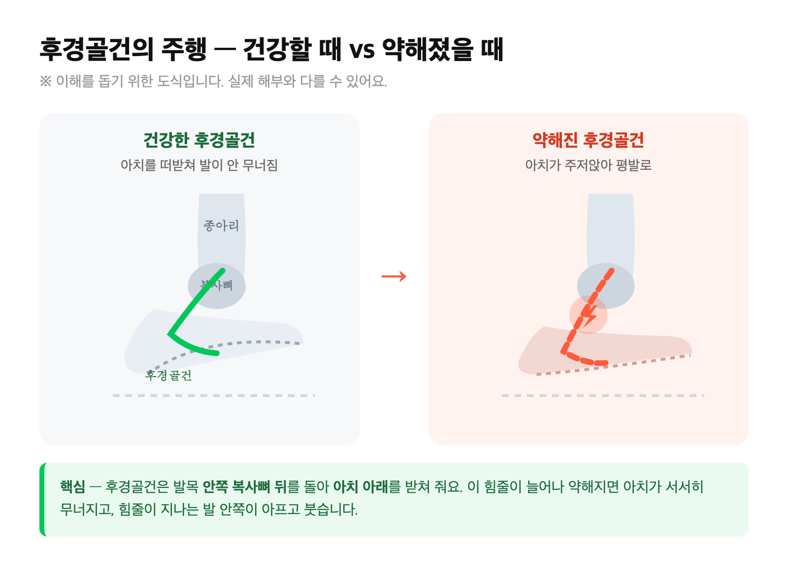 후경골건의 주행 도식 — 발목 안쪽 복사뼈 뒤를 돌아 아치 아래를 받치는 후경골건이 건강할 때(아치 유지)와 약해졌을 때(아치 무너짐) 비교